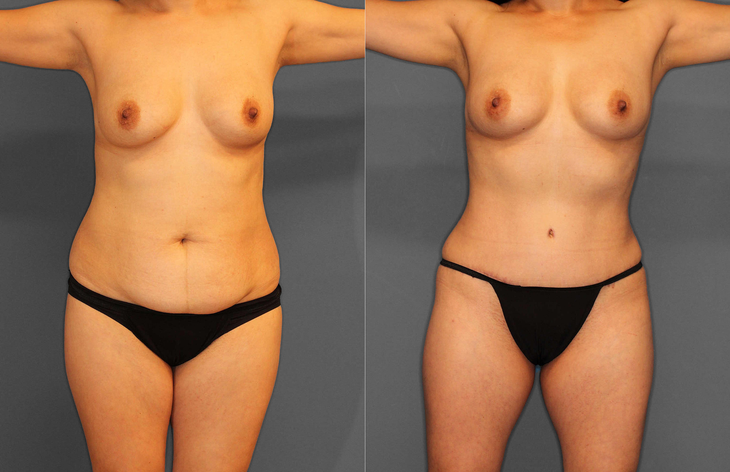 Tummy Tuck:Liposuction Before and After photo by Dr. Abigail Rodriguez in Houston, TX