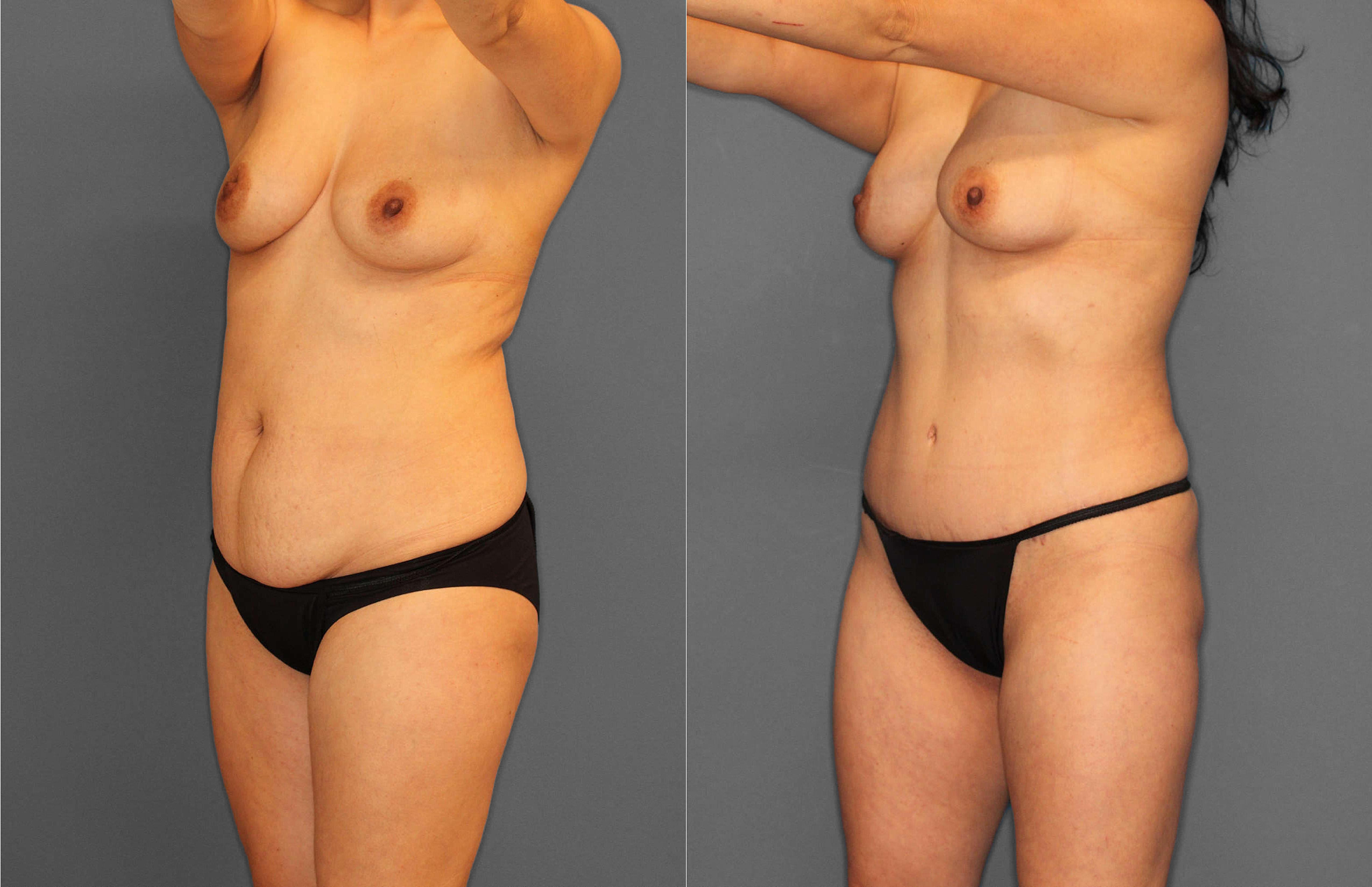 Tummy Tuck:Liposuction Before and After photo by Dr. Abigail Rodriguez in Houston, TX