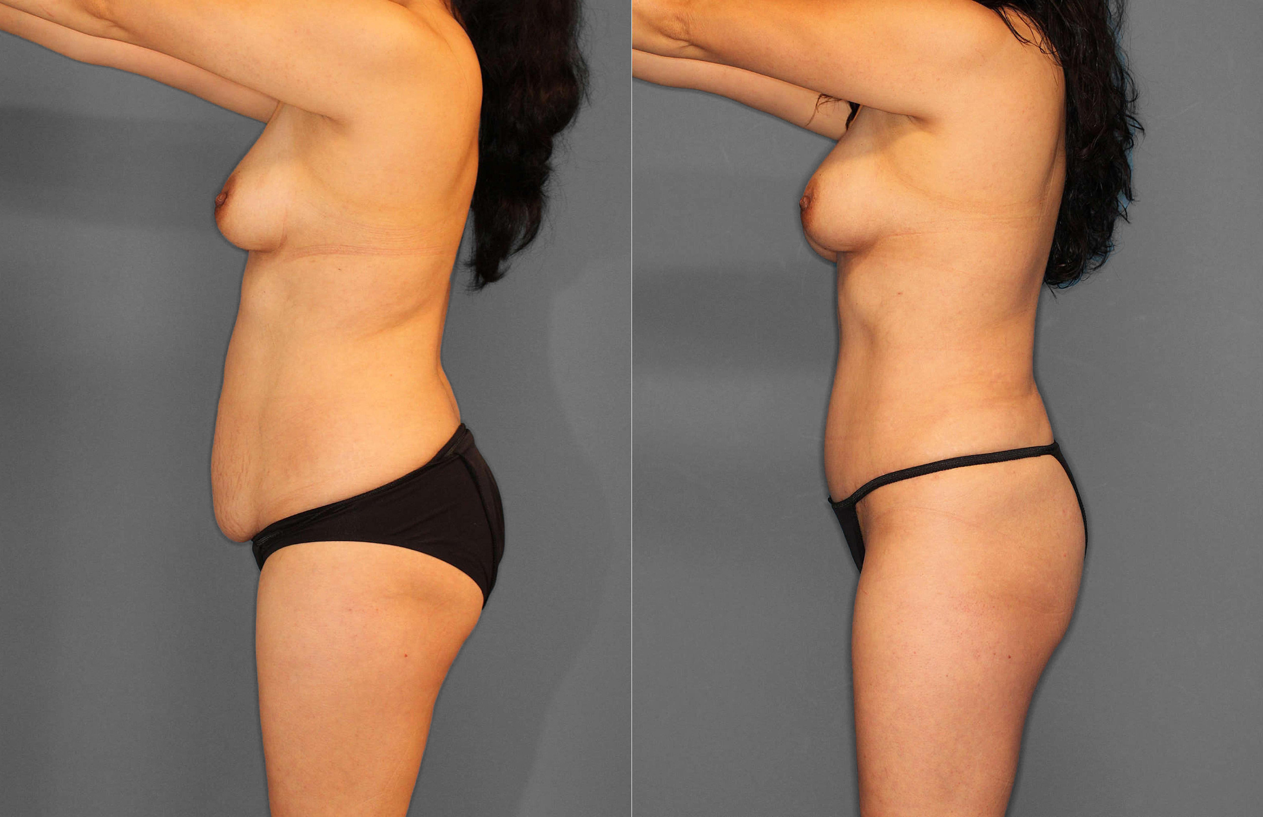 Tummy Tuck:Liposuction Before and After photo by Dr. Abigail Rodriguez in Houston, TX
