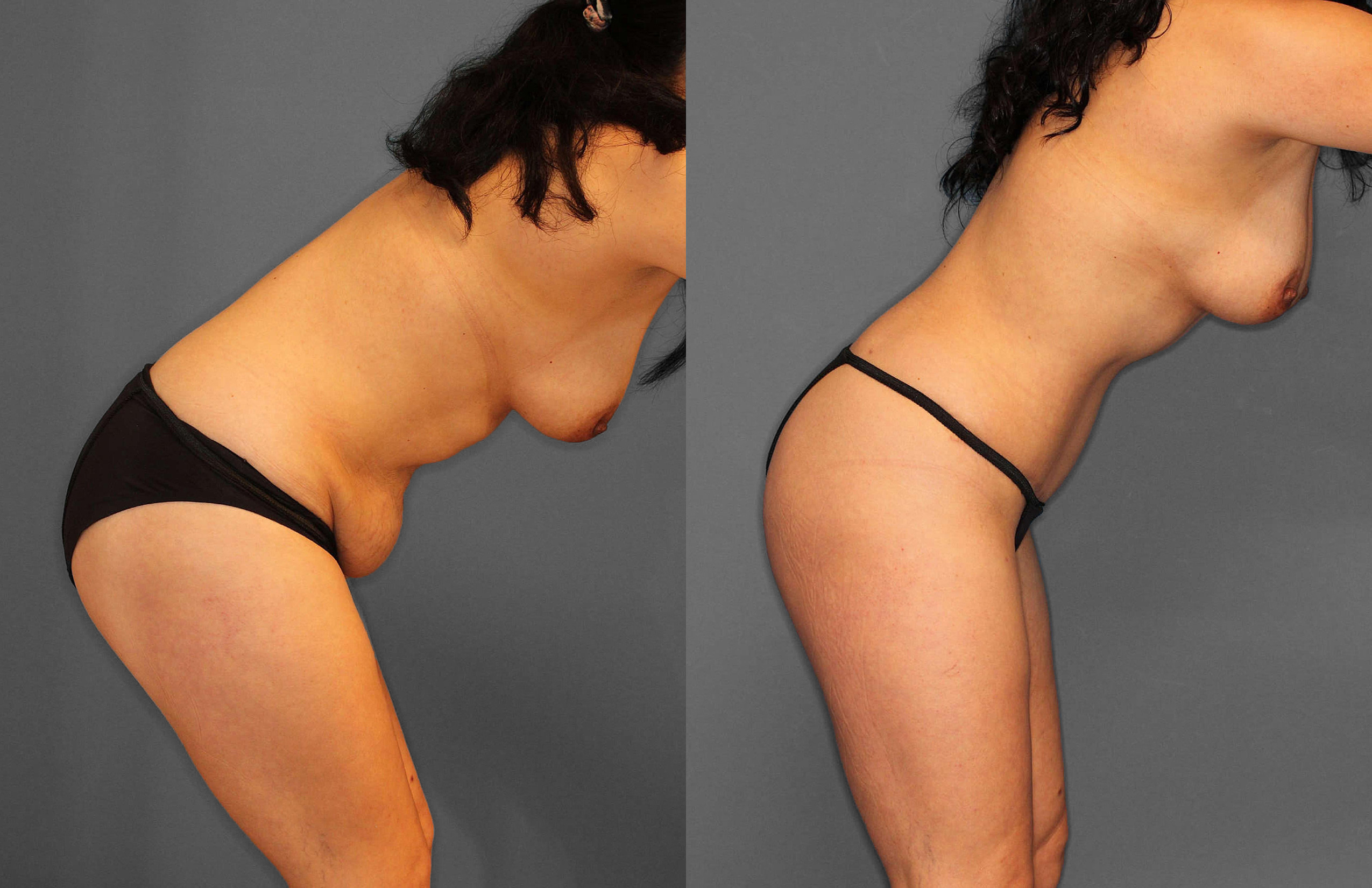 Tummy Tuck:Liposuction Before and After photo by Dr. Abigail Rodriguez in Houston, TX