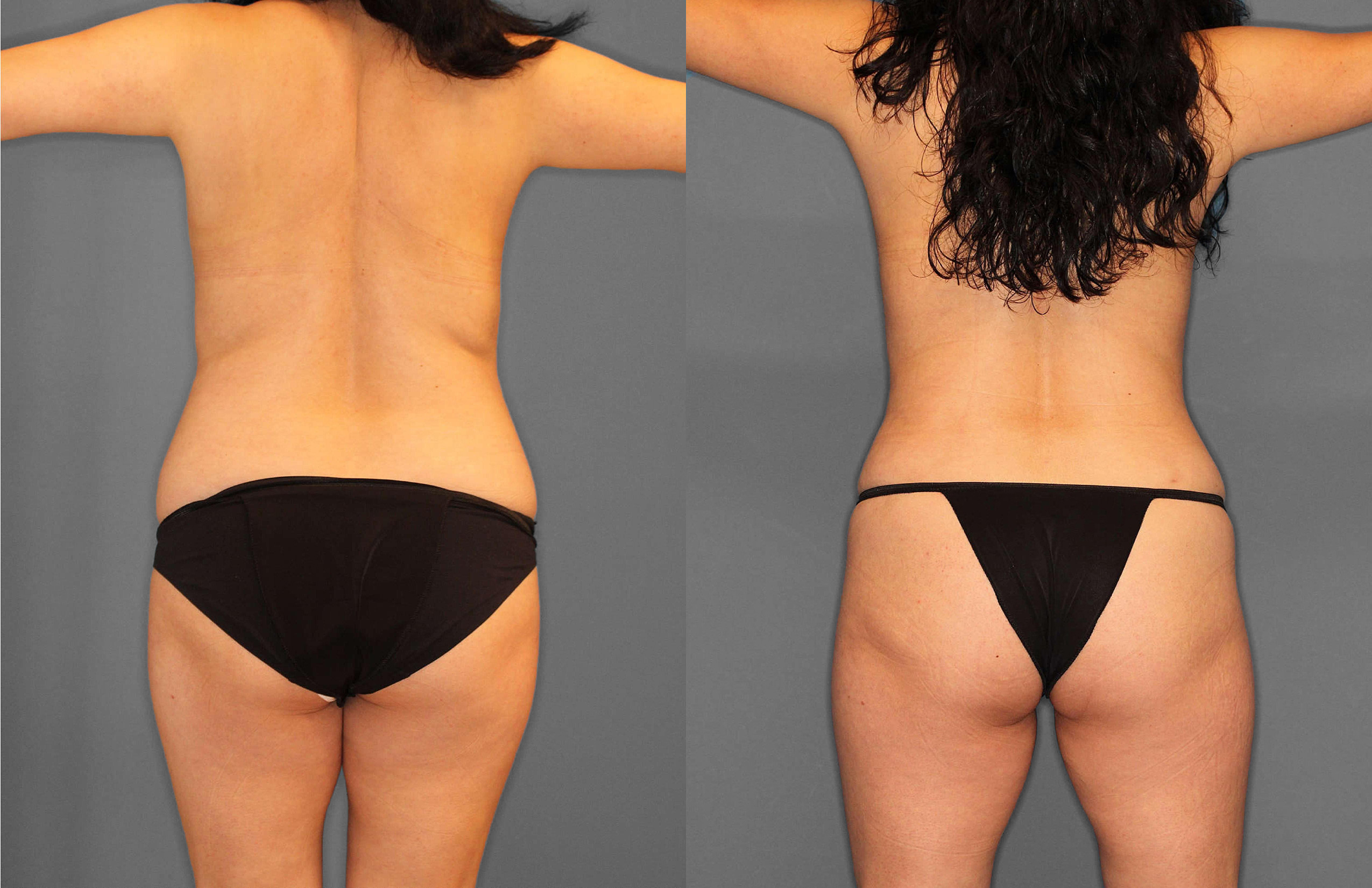 Tummy Tuck:Liposuction Before and After photo by Dr. Abigail Rodriguez in Houston, TX