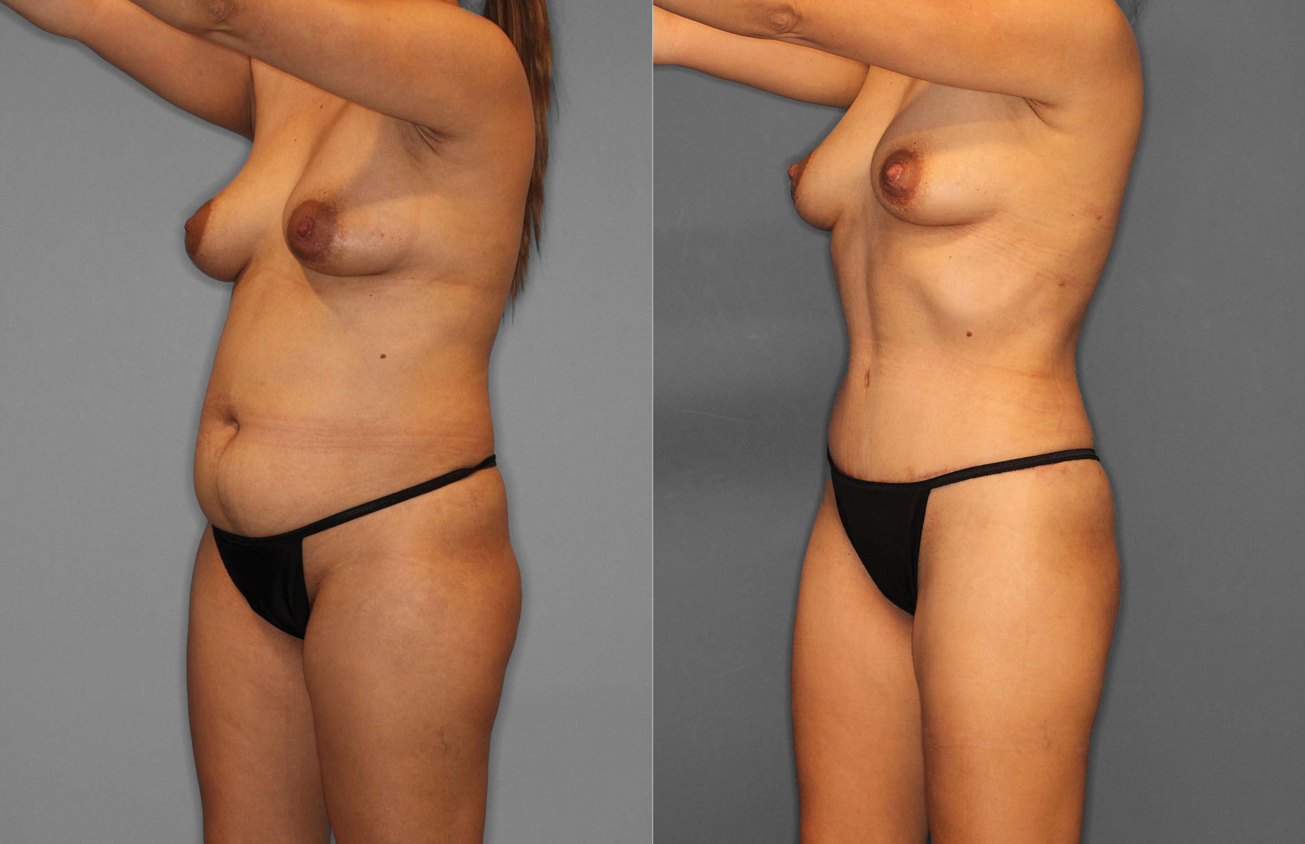 Tummy Tuck:Liposuction Before and After photo by Dr. Abigail Rodriguez in Houston, TX