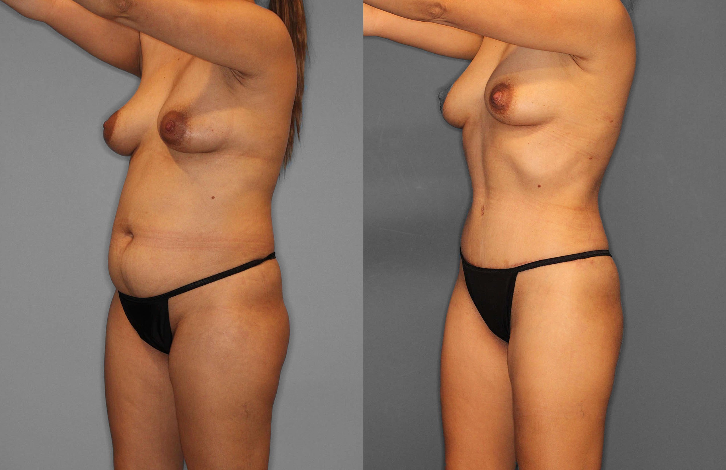 Tummy Tuck:Liposuction Before and After photo by Dr. Abigail Rodriguez in Houston, TX