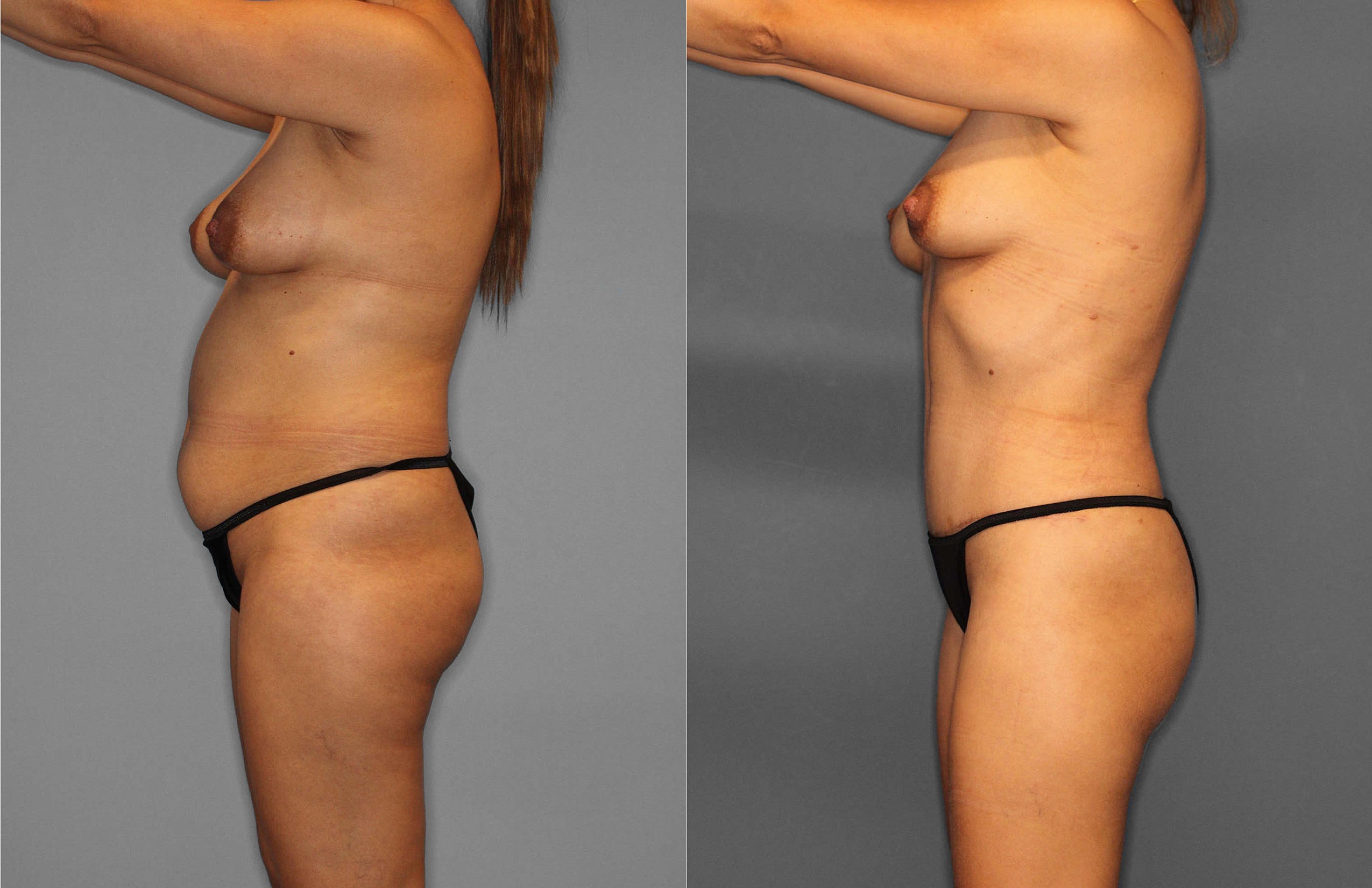 Tummy Tuck:Liposuction Before and After photo by Dr. Abigail Rodriguez in Houston, TX