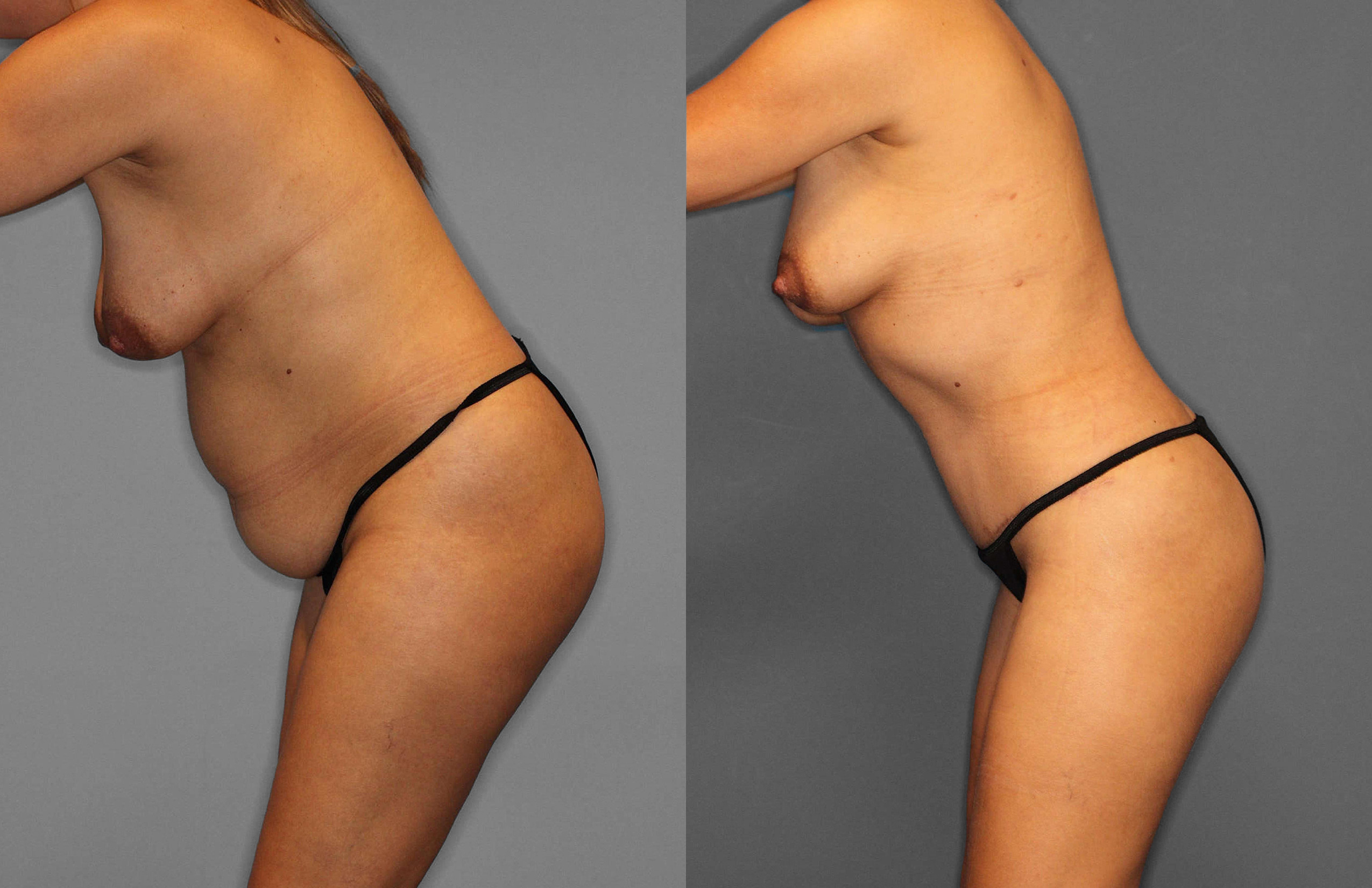 Tummy Tuck:Liposuction Before and After photo by Dr. Abigail Rodriguez in Houston, TX