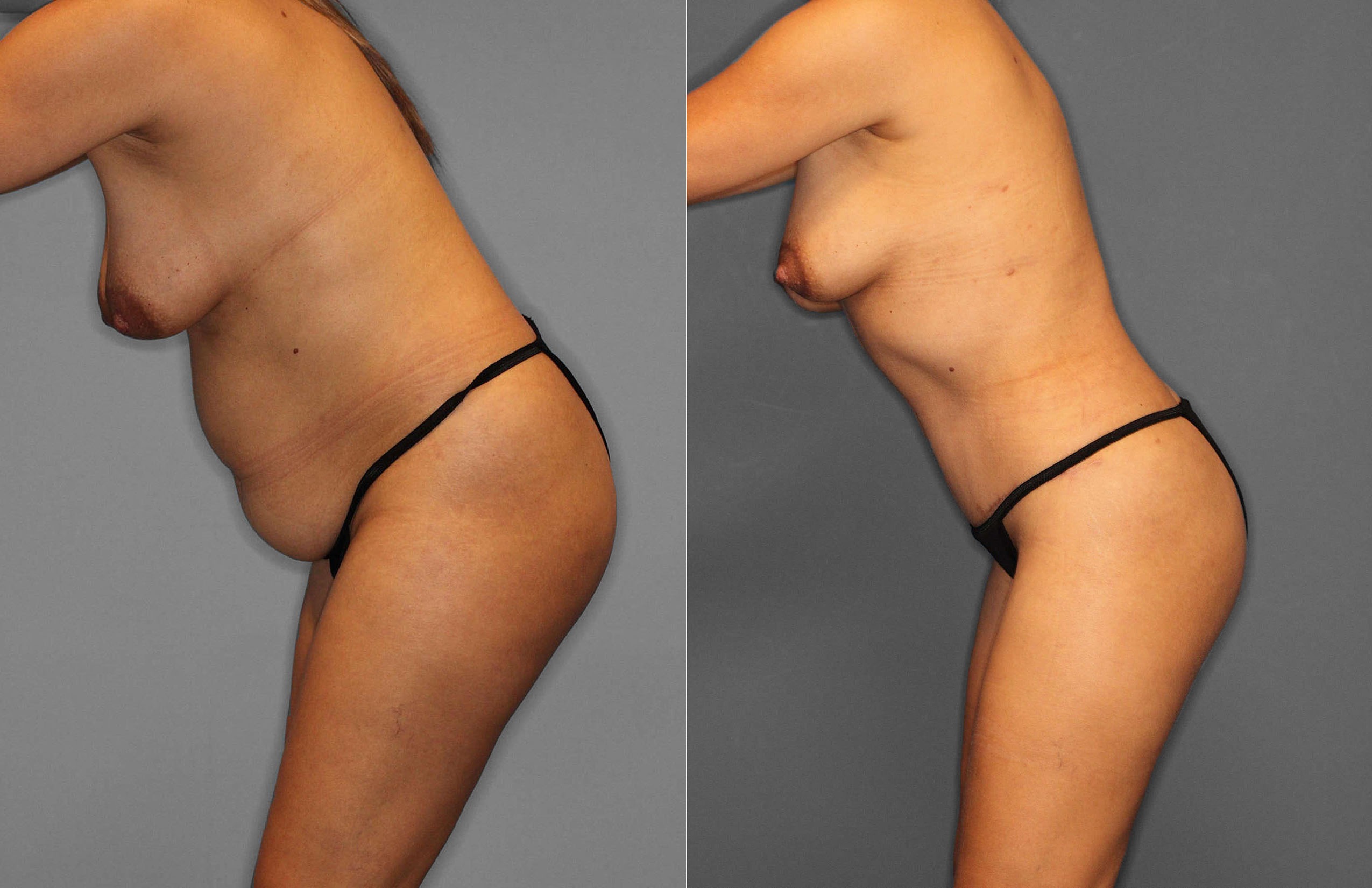 Tummy Tuck:Liposuction Before and After photo by Dr. Abigail Rodriguez in Houston, TX