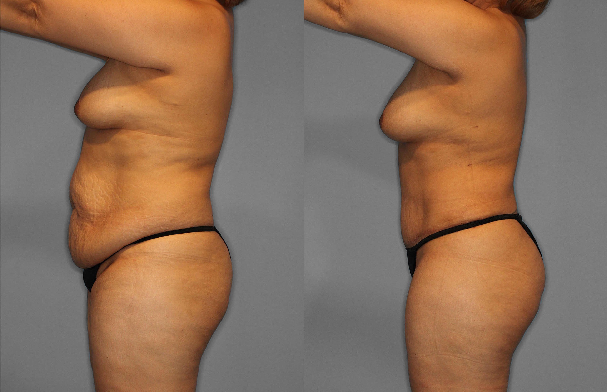 Tummy Tuck:Liposuction Before and After photo by Dr. Abigail Rodriguez in Houston, TX