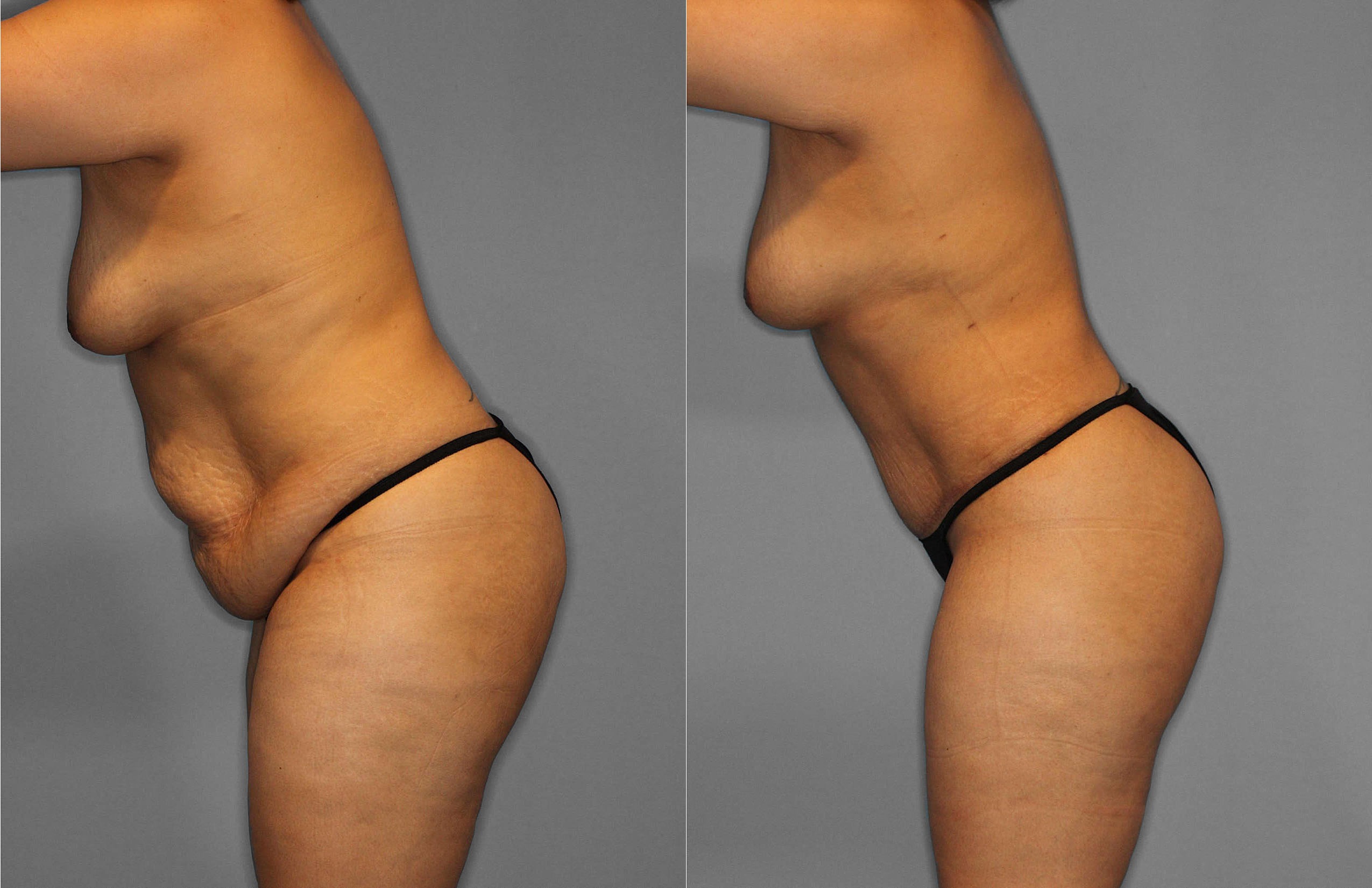 Tummy Tuck:Liposuction Before and After photo by Dr. Abigail Rodriguez in Houston, TX