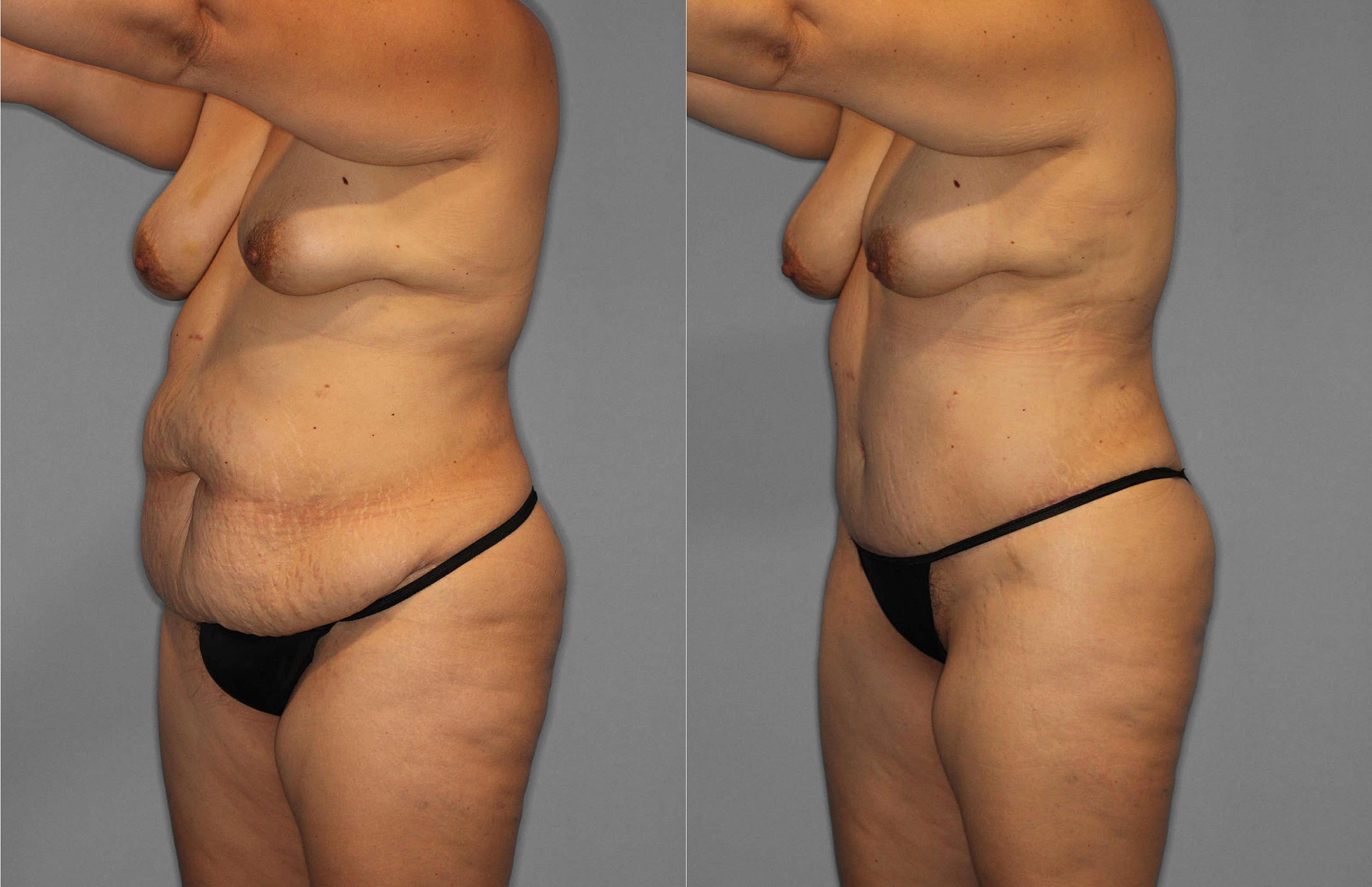 Tummy Tuck:Liposuction Before and After photo by Dr. Abigail Rodriguez in Houston, TX