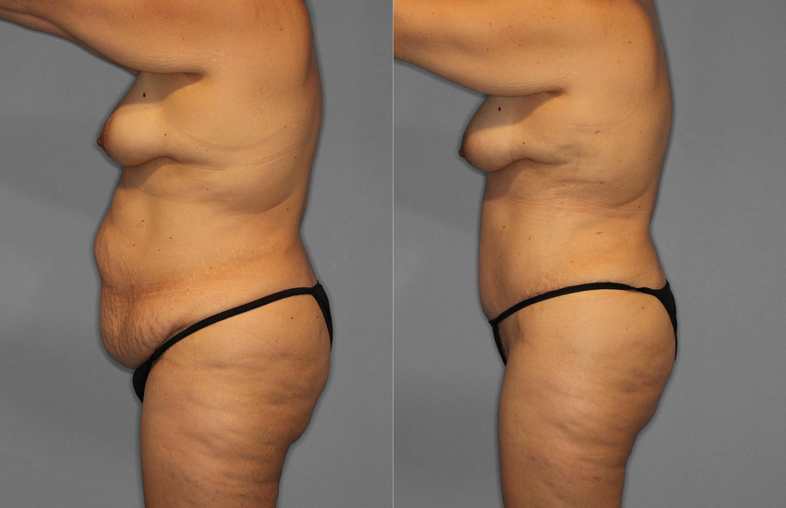 Tummy Tuck:Liposuction Before and After photo by Dr. Abigail Rodriguez in Houston, TX