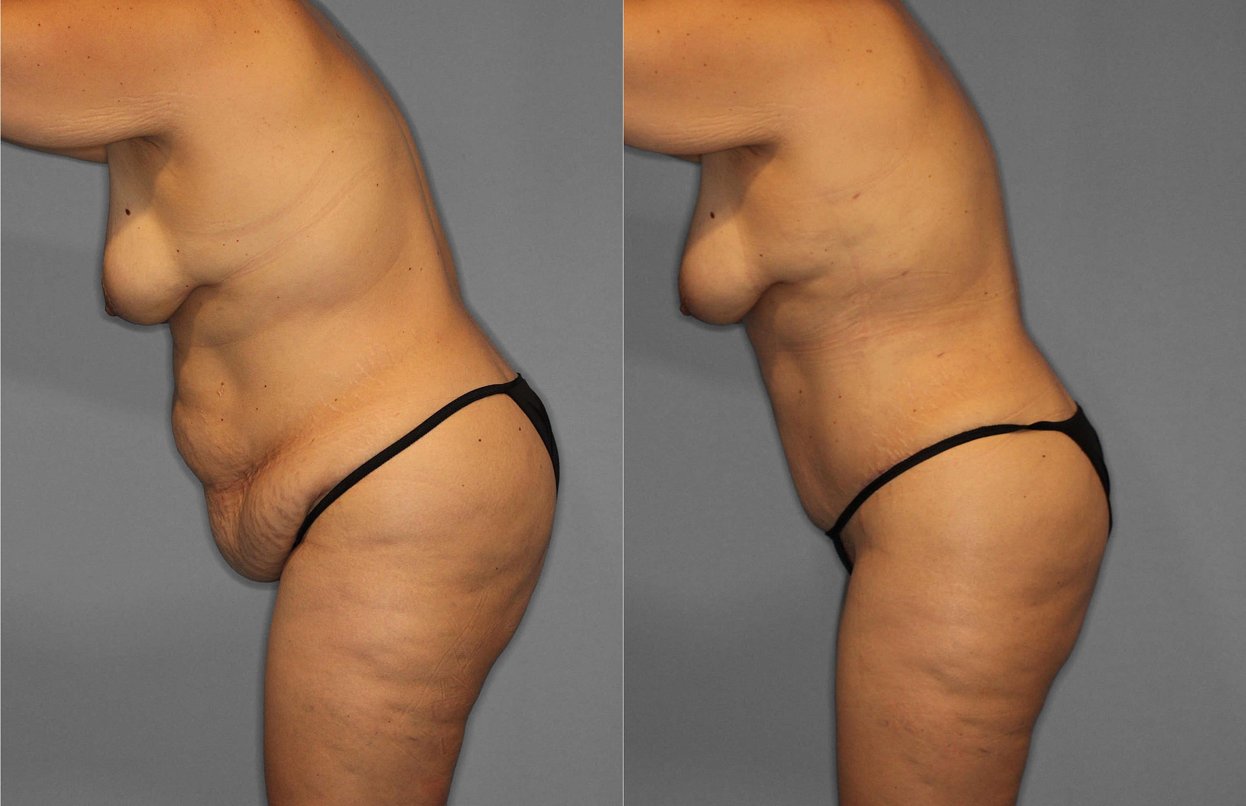 Tummy Tuck:Liposuction Before and After photo by Dr. Abigail Rodriguez in Houston, TX
