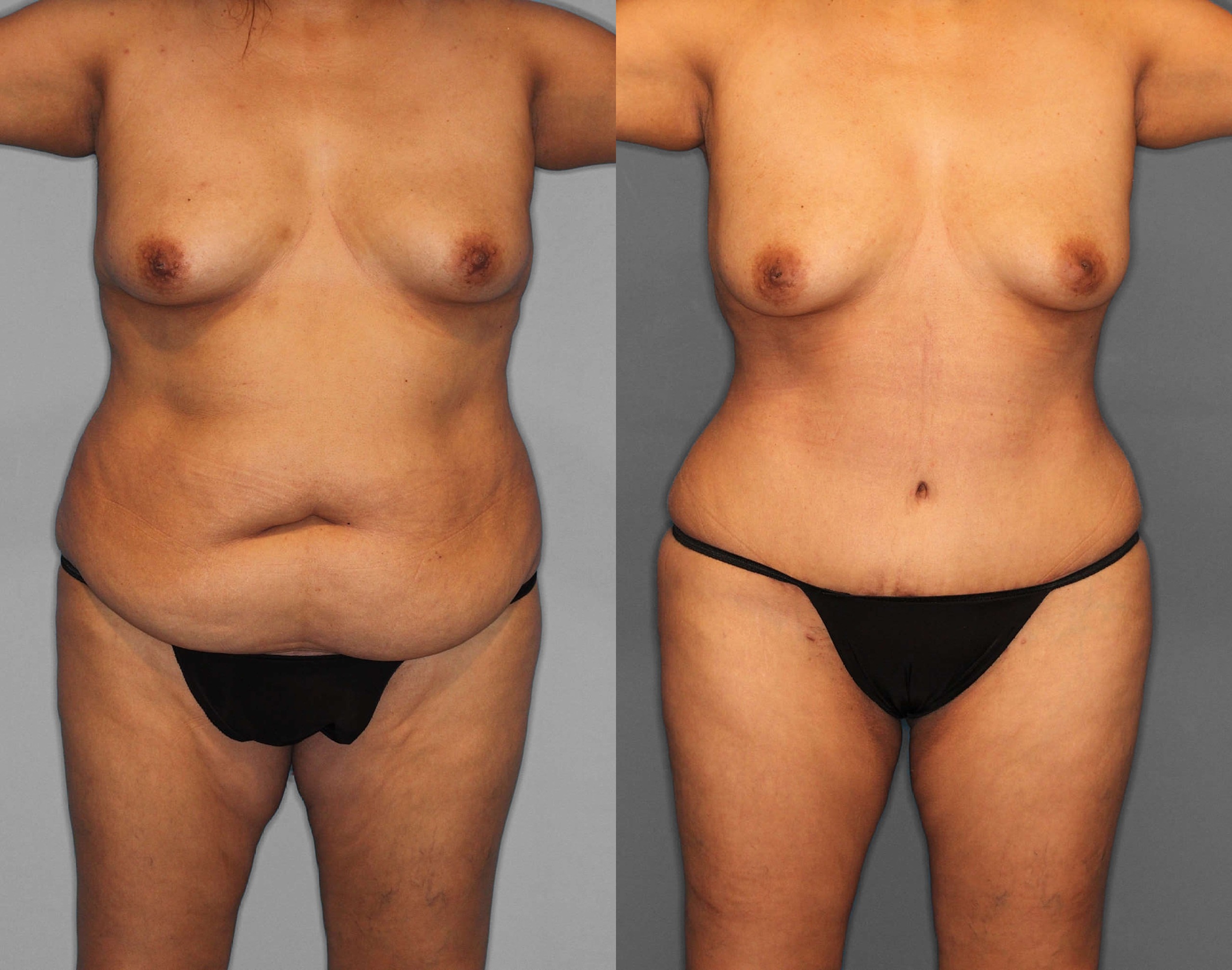 Tummy Tuck:Liposuction:BBL Before and After photo by Dr. Abigail Rodriguez in Houston, TX