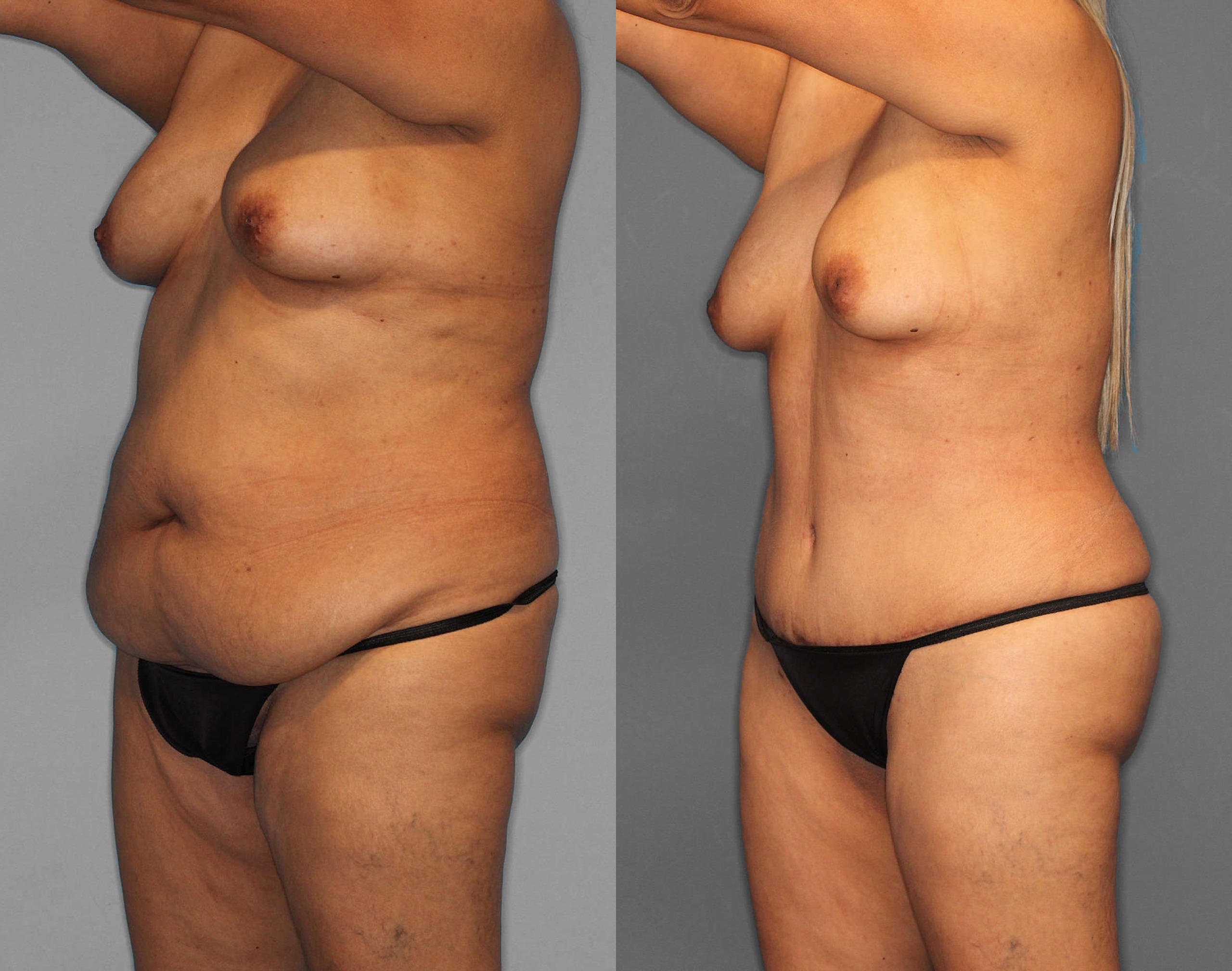 Tummy Tuck:Liposuction:BBL Before and After photo by Dr. Abigail Rodriguez in Houston, TX