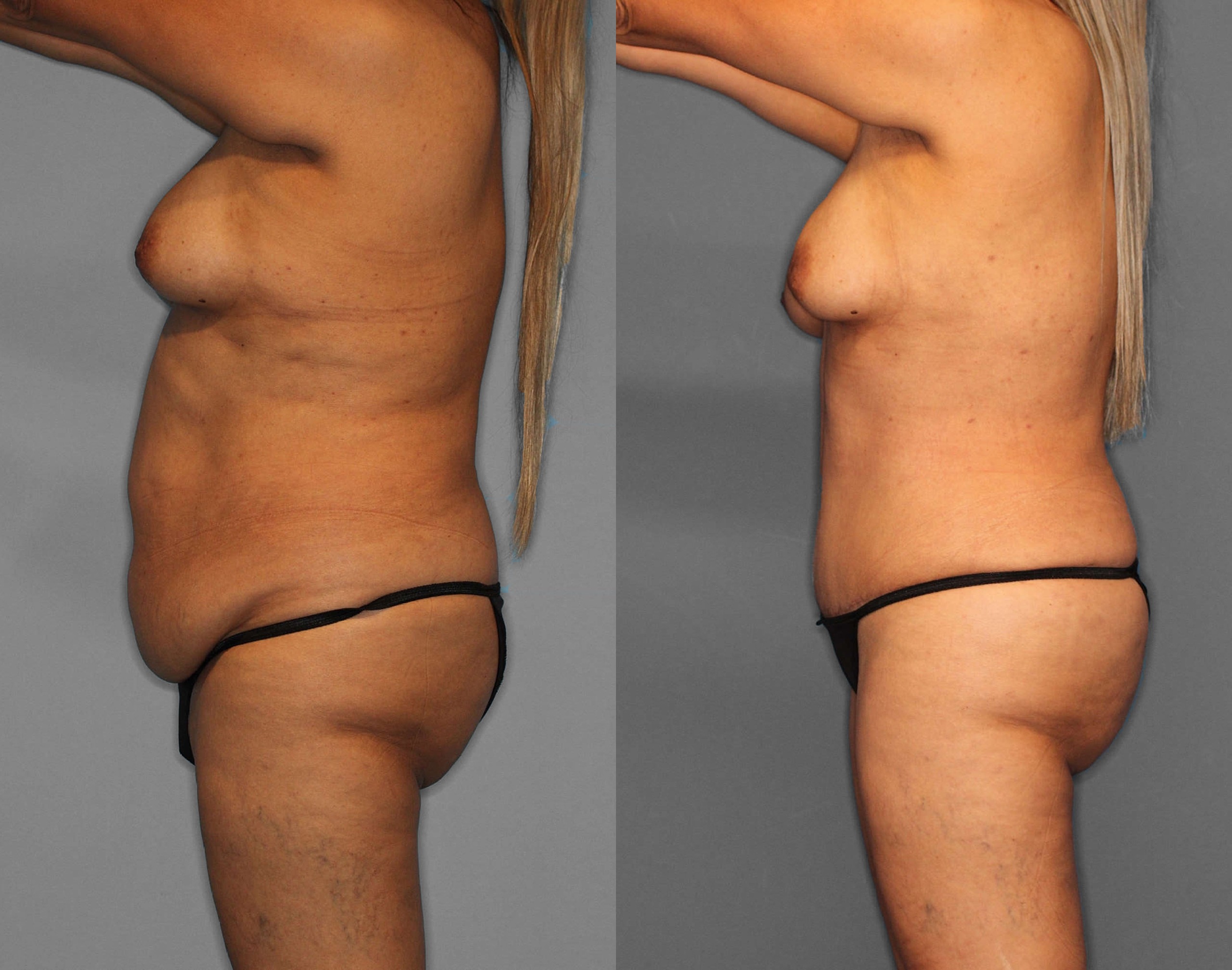 Tummy Tuck:Liposuction:BBL Before and After photo by Dr. Abigail Rodriguez in Houston, TX