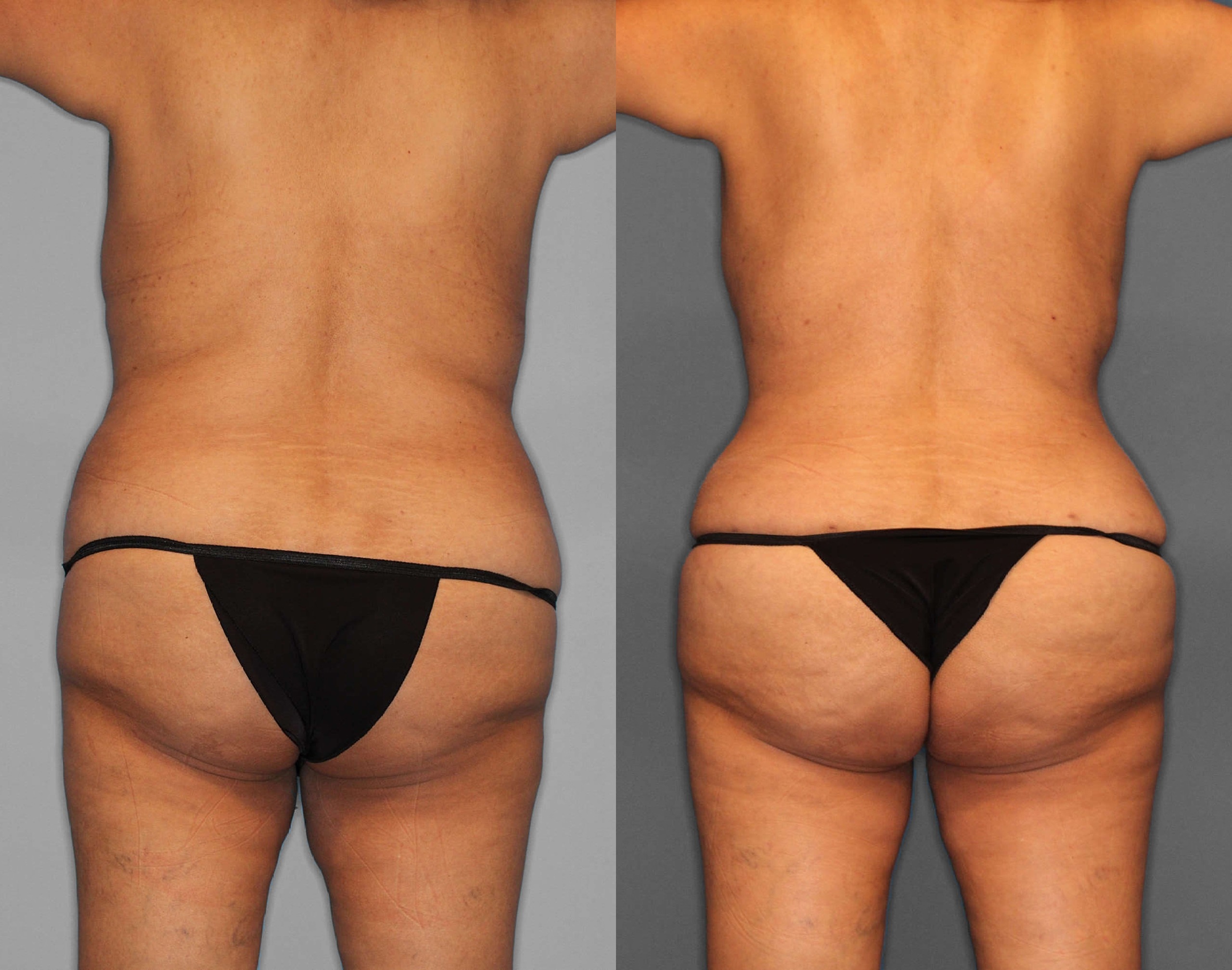 Tummy Tuck:Liposuction:BBL Before and After photo by Dr. Abigail Rodriguez in Houston, TX