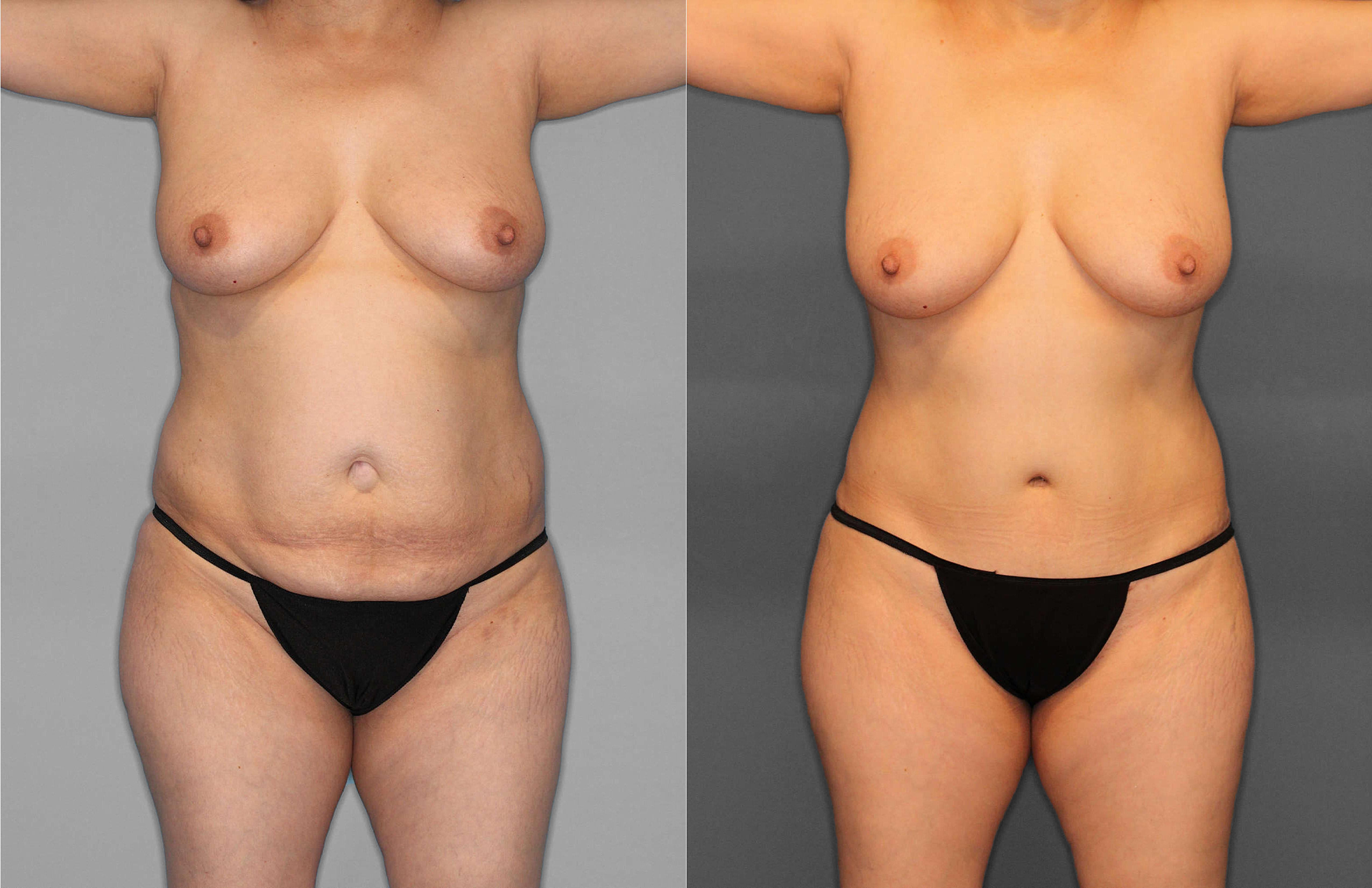 Tummy Tuck:Liposuction:Hernia Before and After photo by Dr. Abigail Rodriguez in Houston, TX