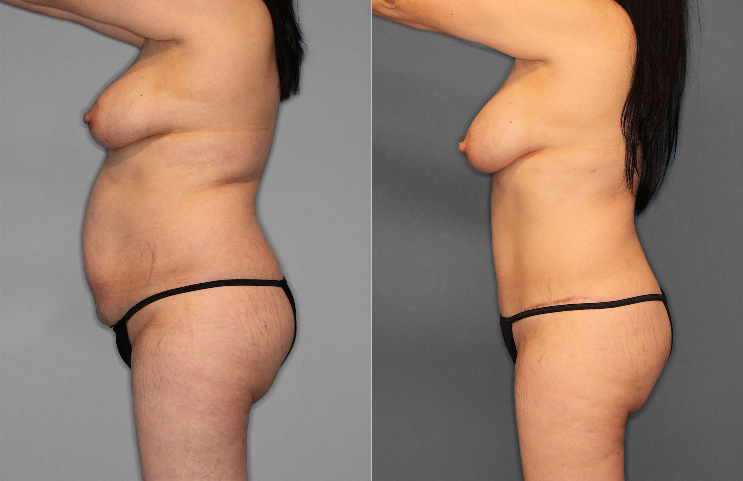 Tummy Tuck:Liposuction:Hernia Before and After photo by Dr. Abigail Rodriguez in Houston, TX