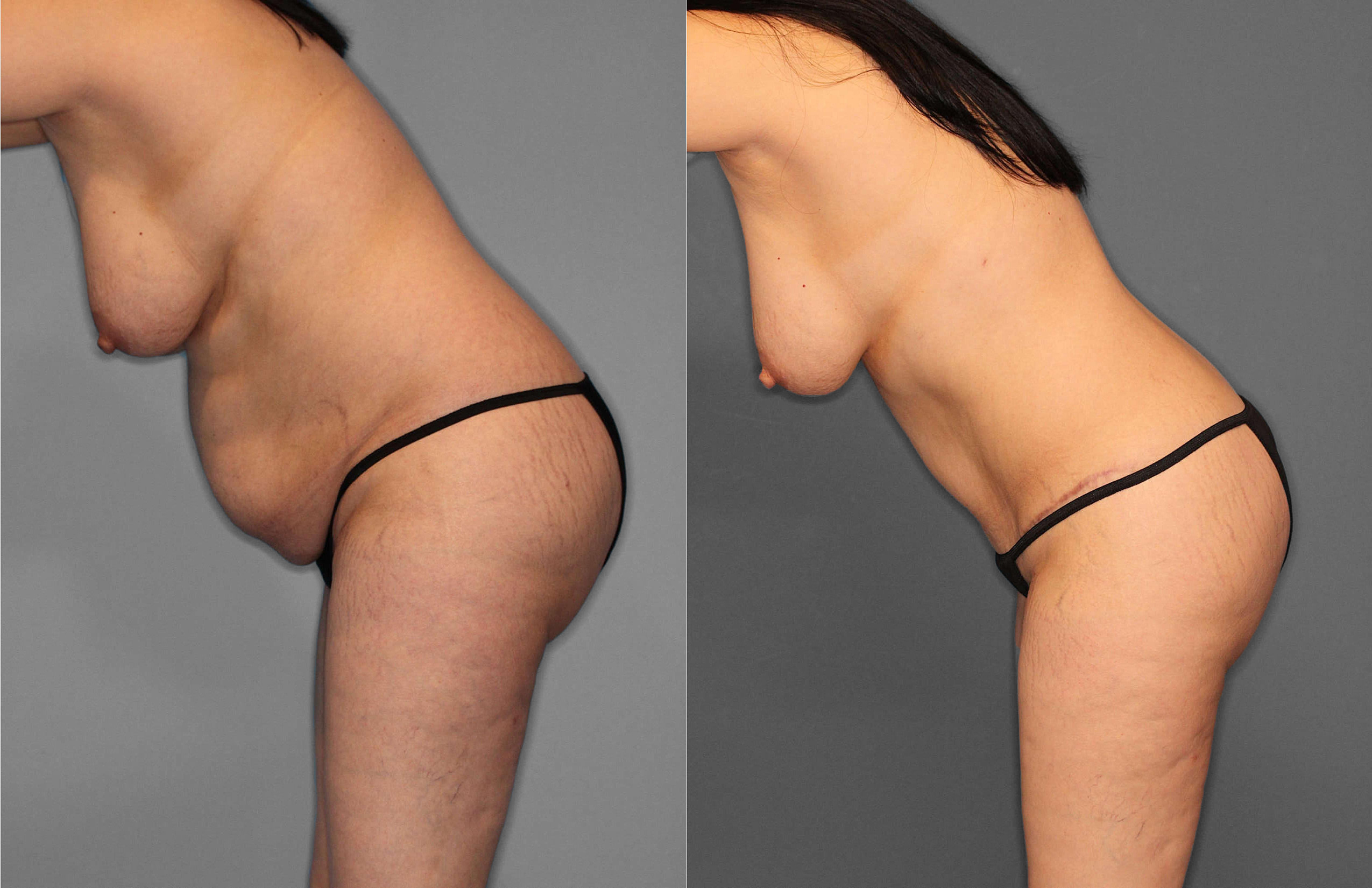 Tummy Tuck:Liposuction:Hernia Before and After photo by Dr. Abigail Rodriguez in Houston, TX
