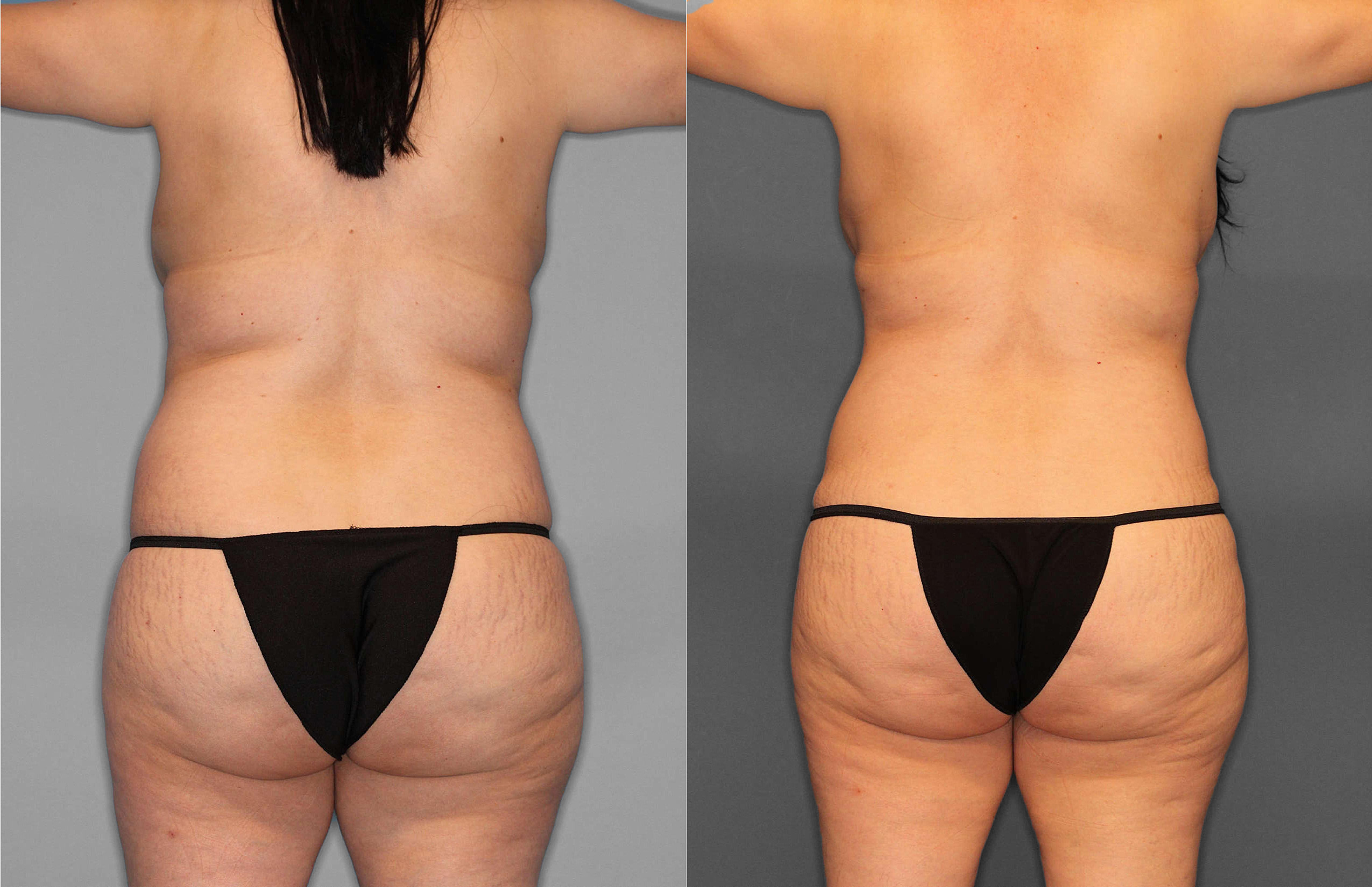 Tummy Tuck:Liposuction:Hernia Before and After photo by Dr. Abigail Rodriguez in Houston, TX