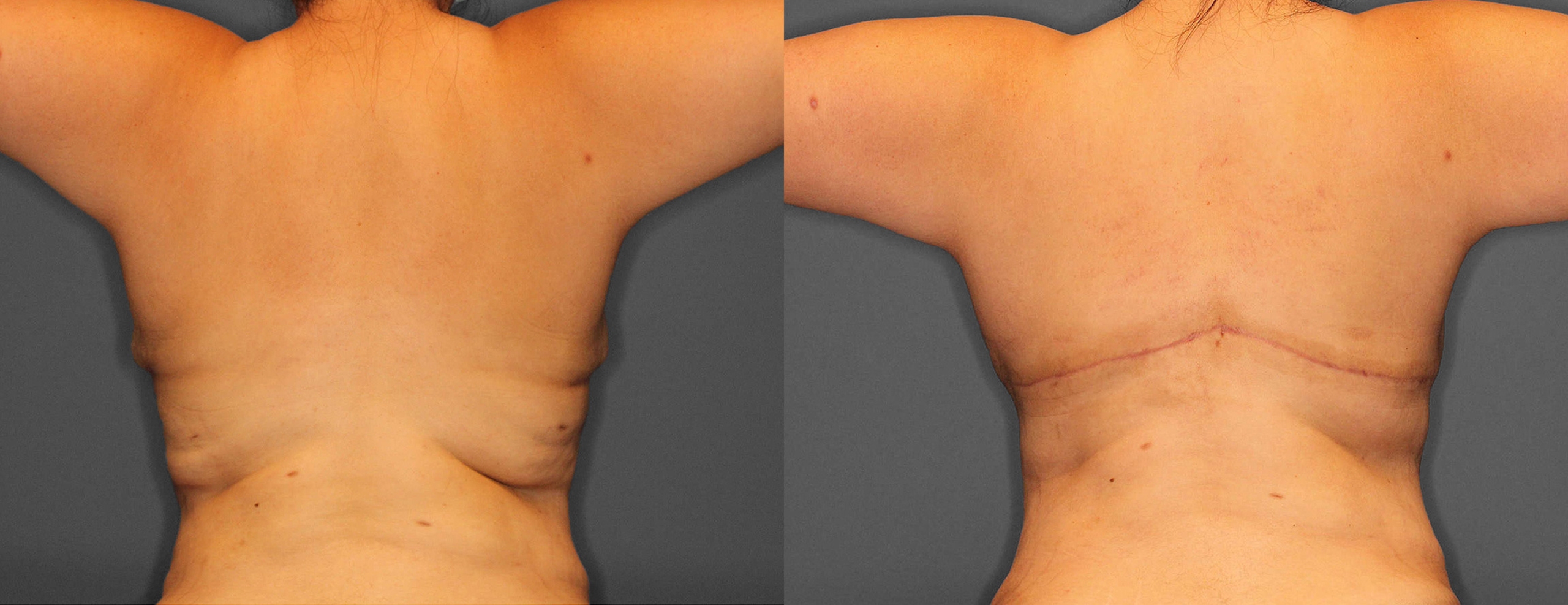 Bra Line Lift Before and After photo by Dr. Abigail Rodriguez in Houston, TX