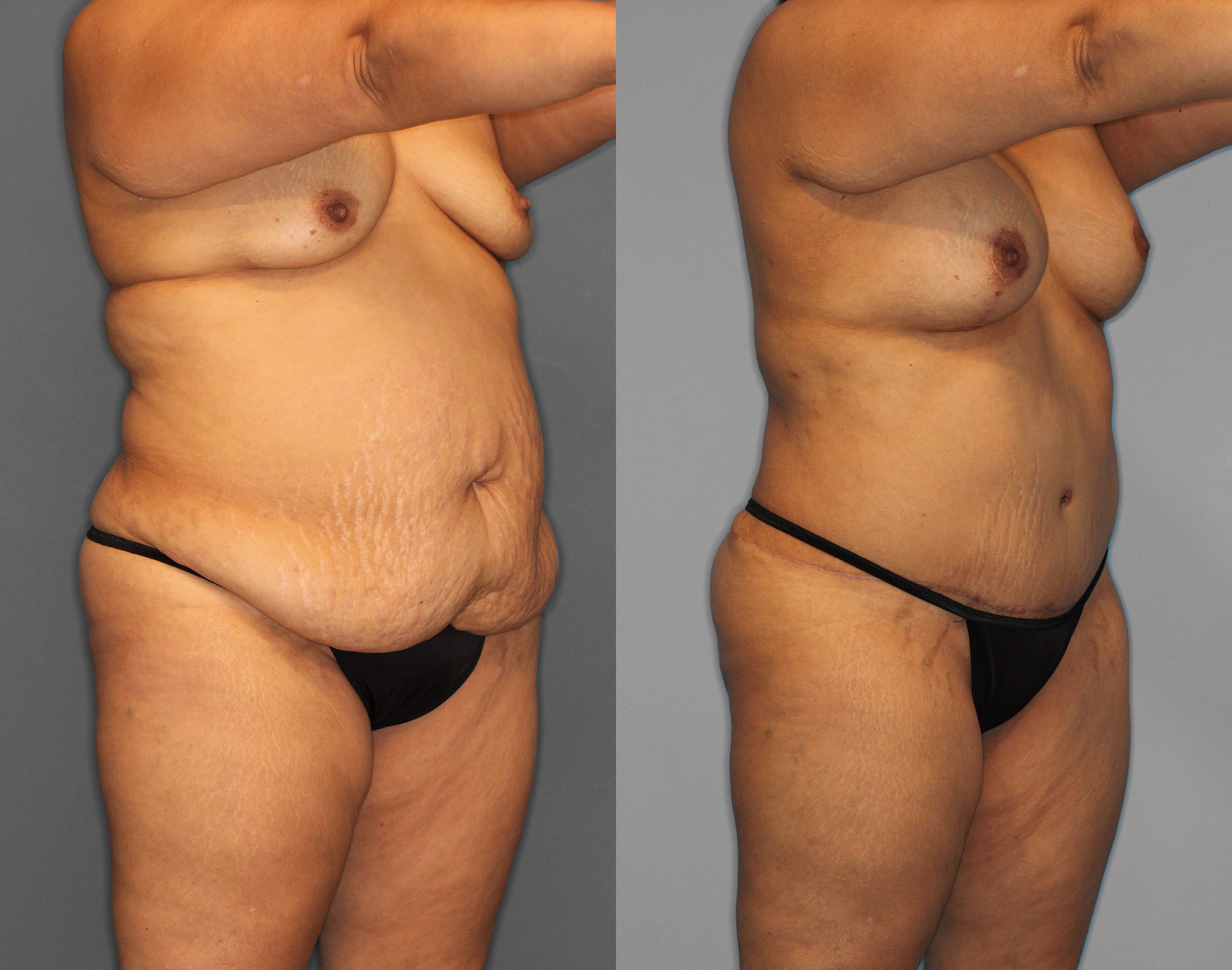 Tummy Tuck Before and After photo by Dr. Abigail Rodriguez in Houston, TX