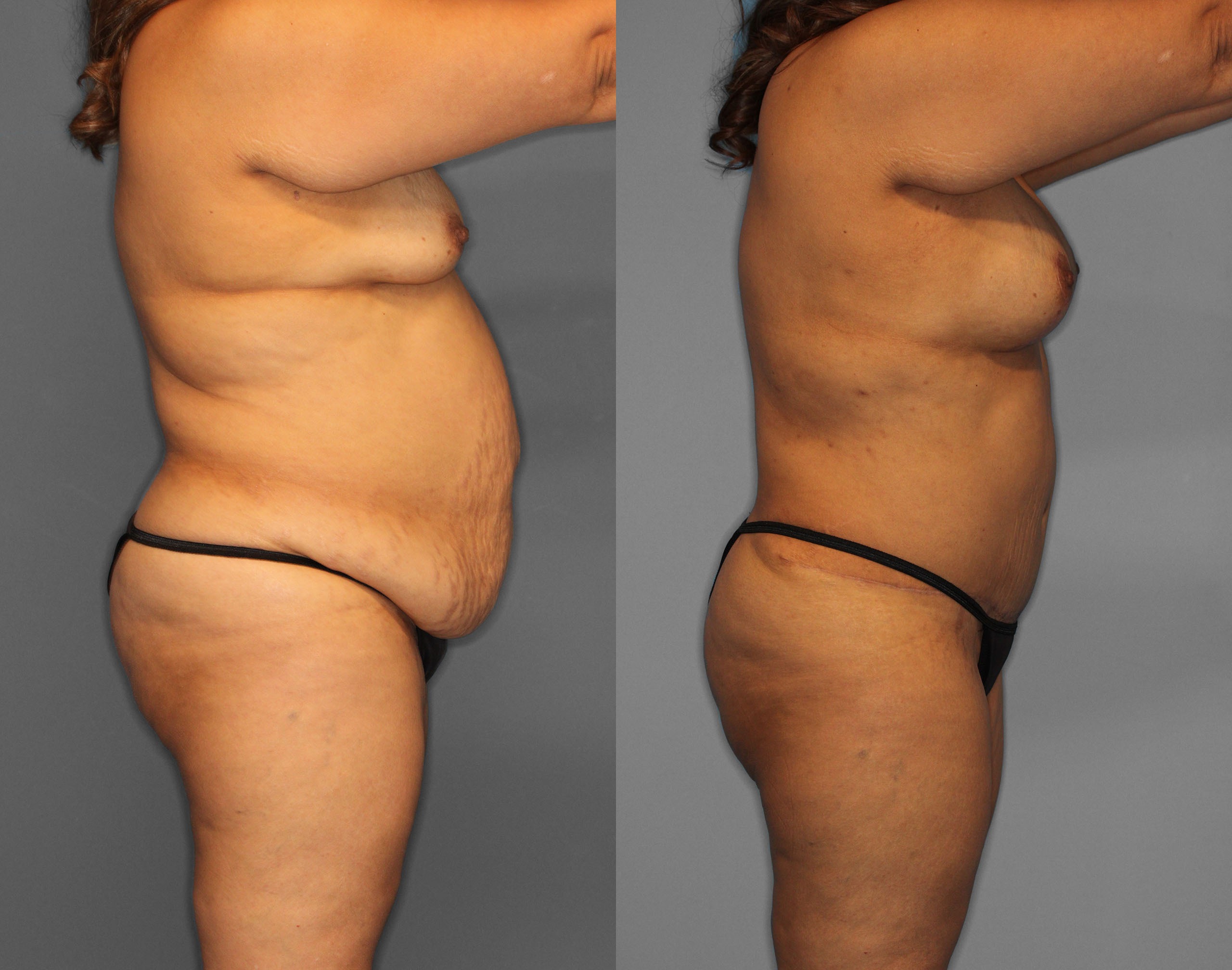 Tummy Tuck Before and After photo by Dr. Abigail Rodriguez in Houston, TX