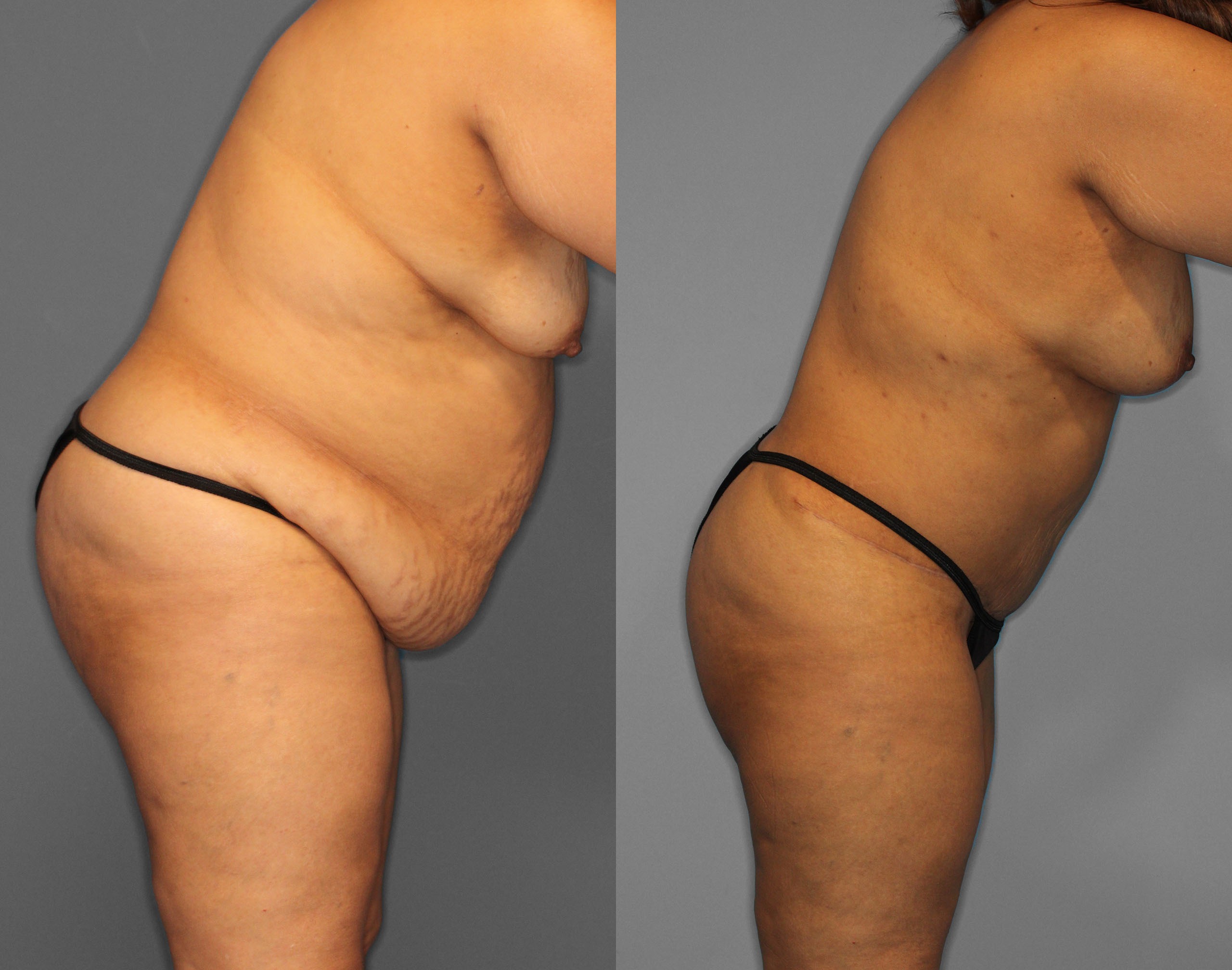 Tummy Tuck Before and After photo by Dr. Abigail Rodriguez in Houston, TX