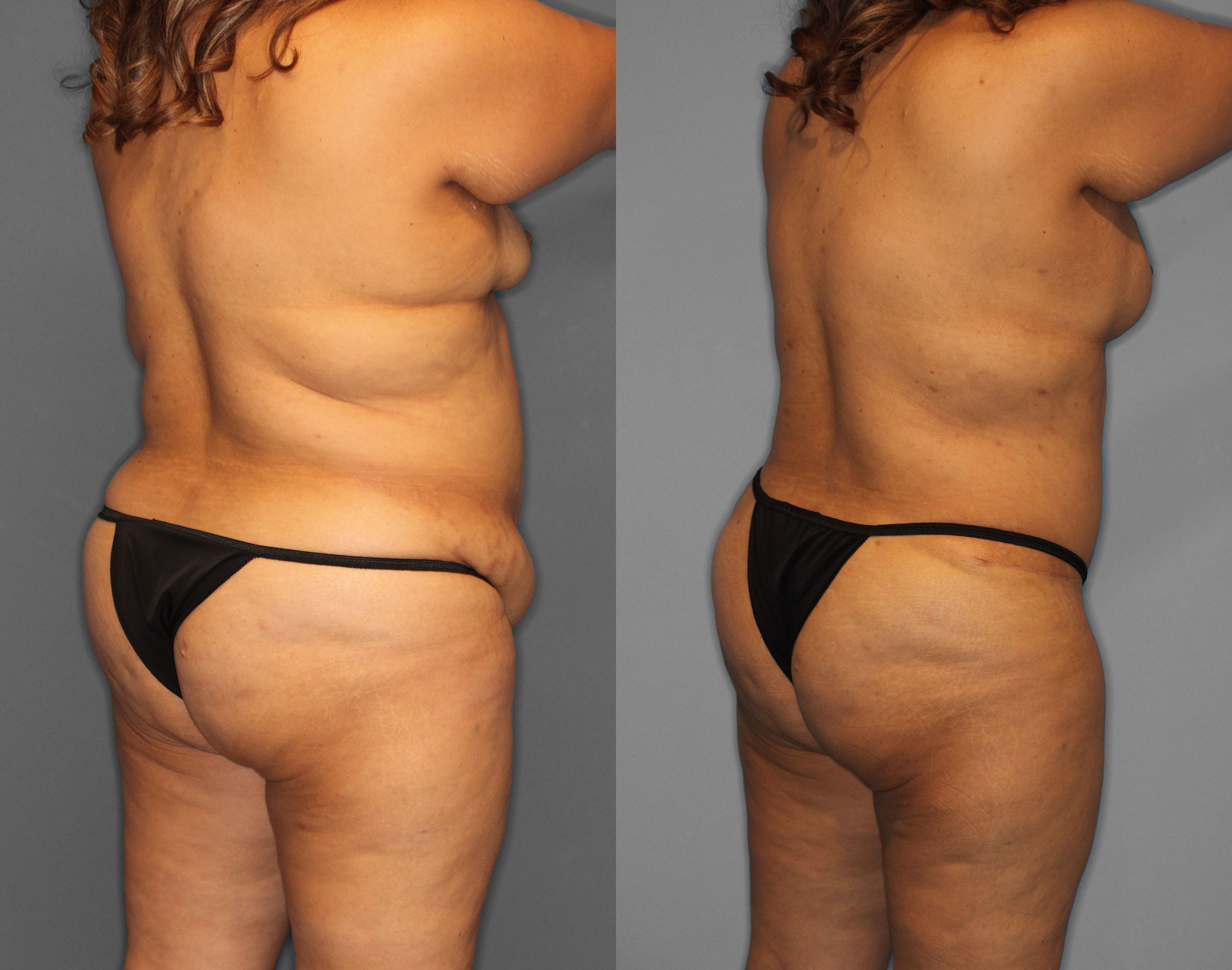 Tummy Tuck Before and After photo by Dr. Abigail Rodriguez in Houston, TX