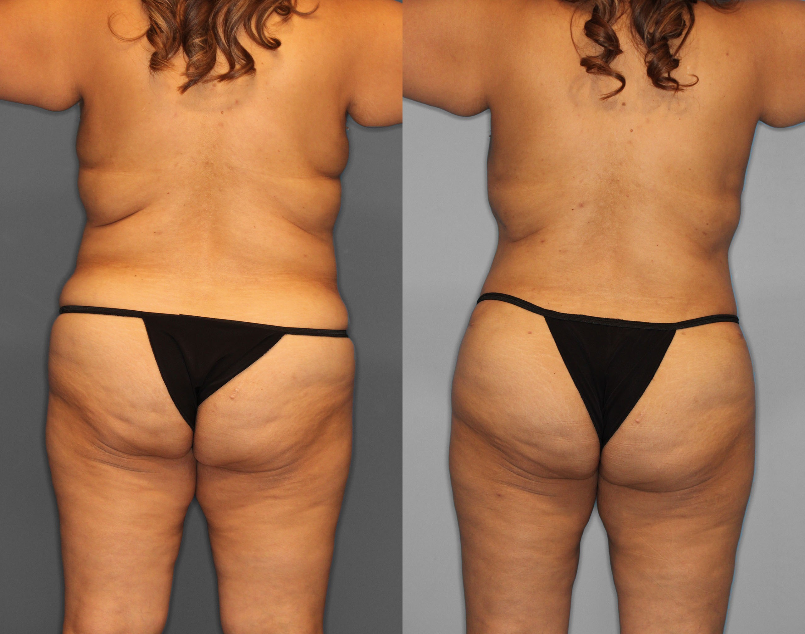 Tummy Tuck Before and After photo by Dr. Abigail Rodriguez in Houston, TX