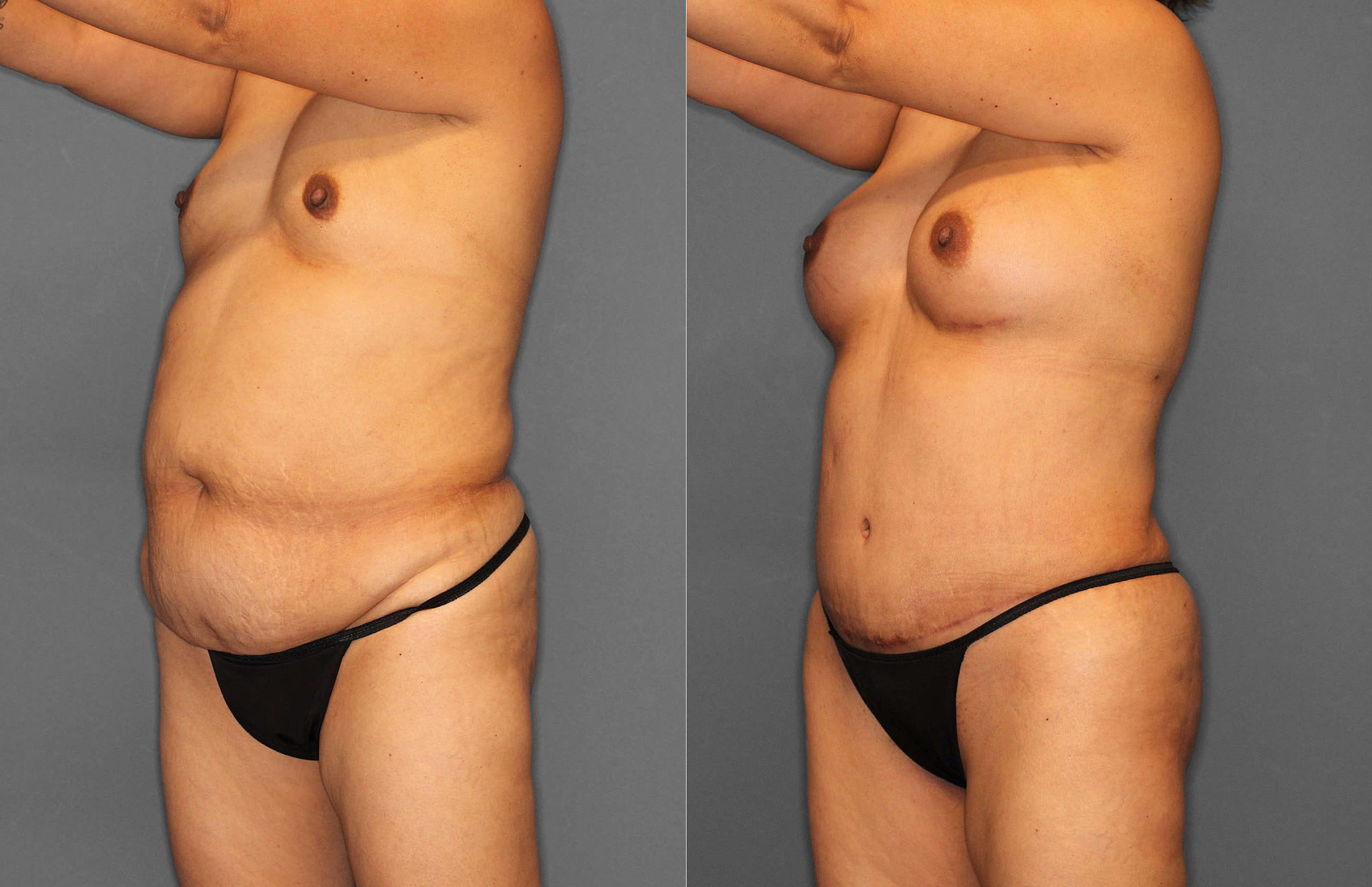 Tummy Tuck:Liposuction Before and After photo by Dr. Abigail Rodriguez in Houston, TX