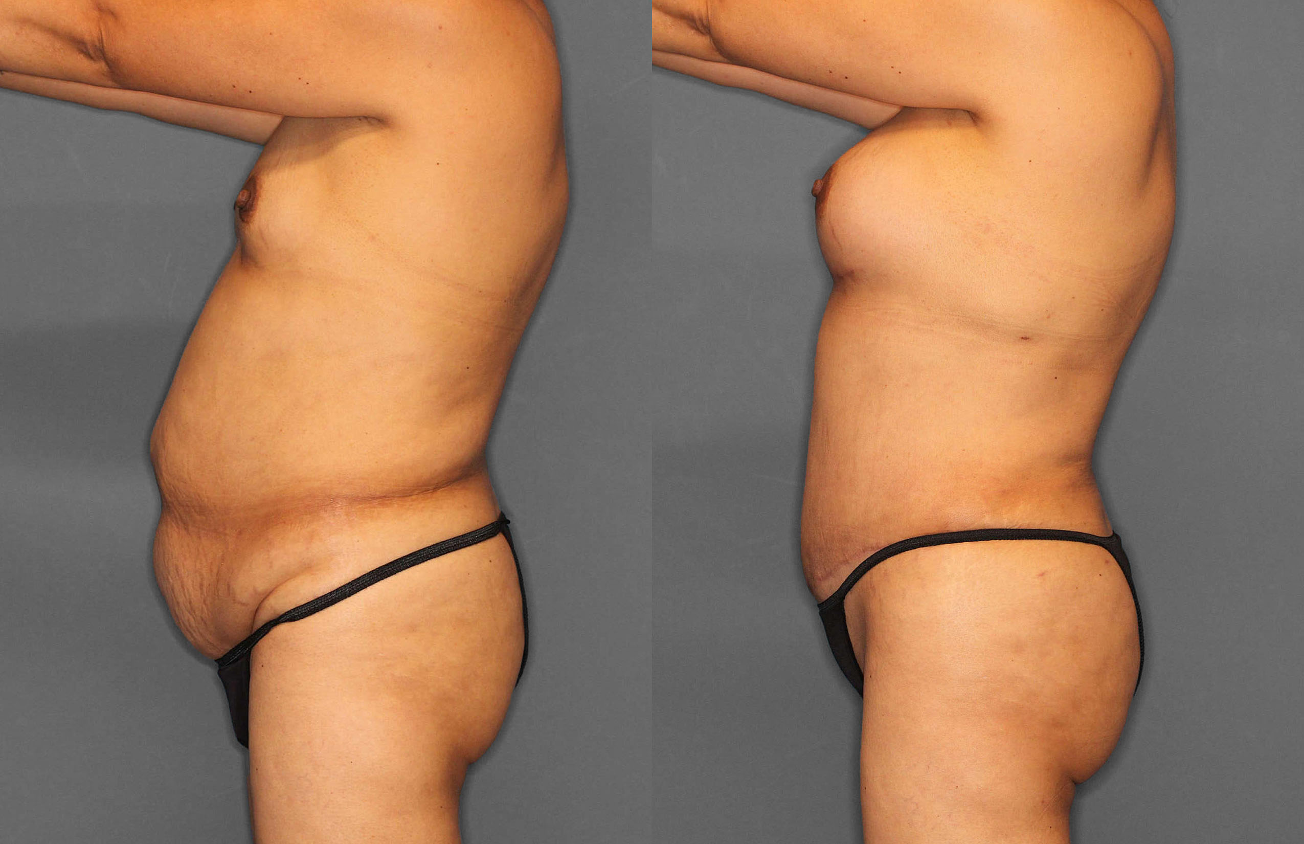 Tummy Tuck:Liposuction Before and After photo by Dr. Abigail Rodriguez in Houston, TX