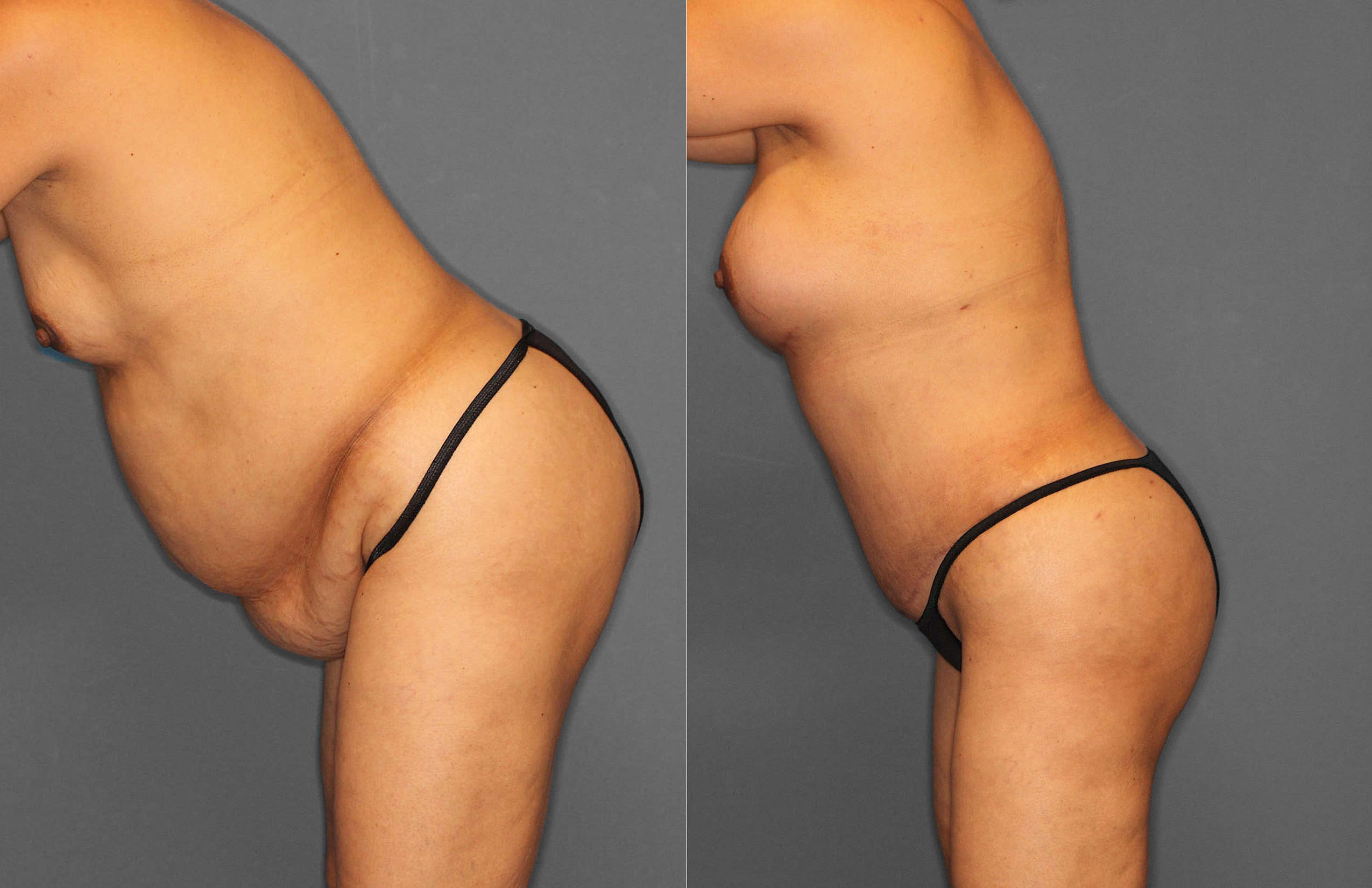 Tummy Tuck:Liposuction Before and After photo by Dr. Abigail Rodriguez in Houston, TX