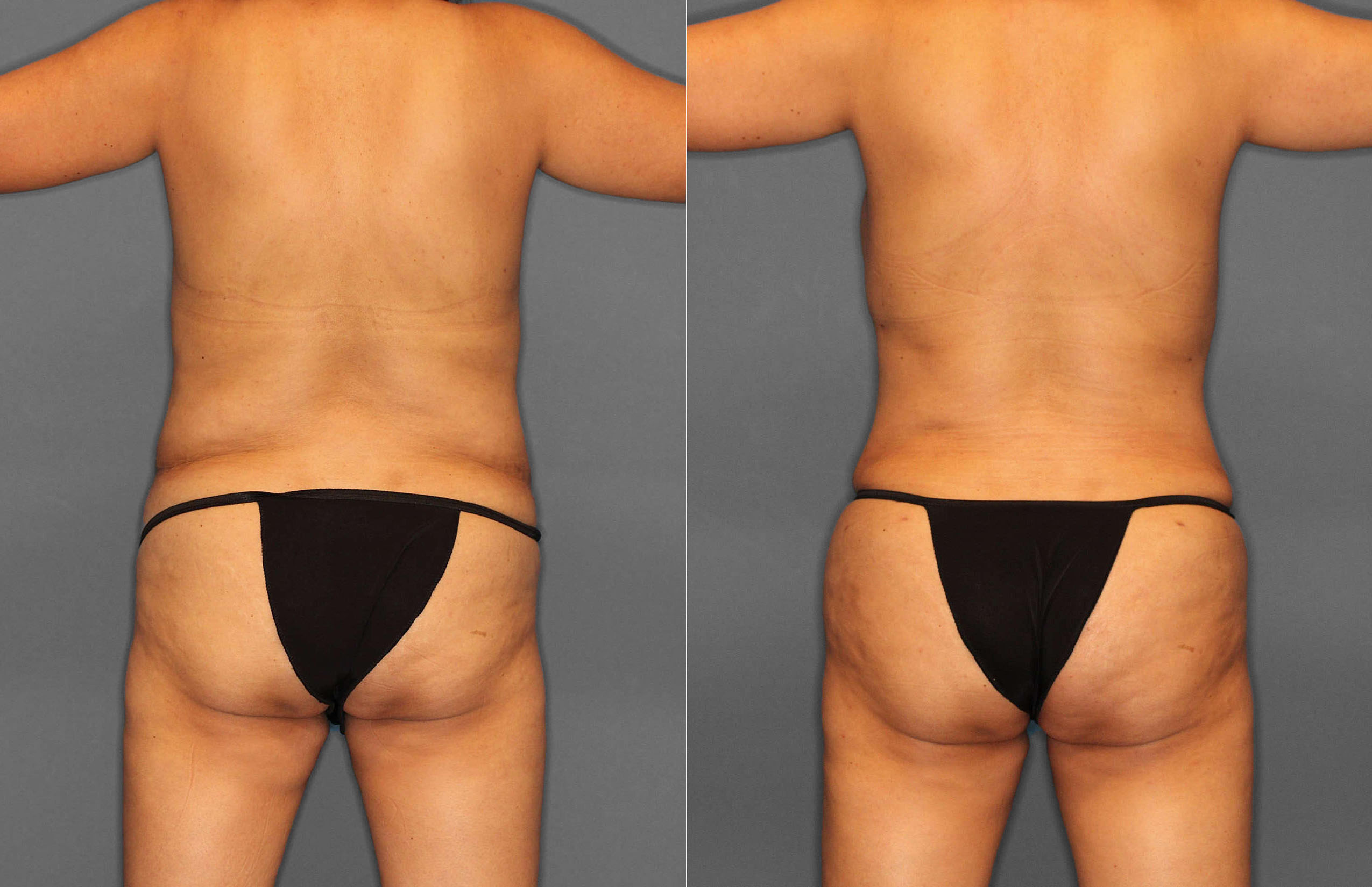 Tummy Tuck:Liposuction Before and After photo by Dr. Abigail Rodriguez in Houston, TX