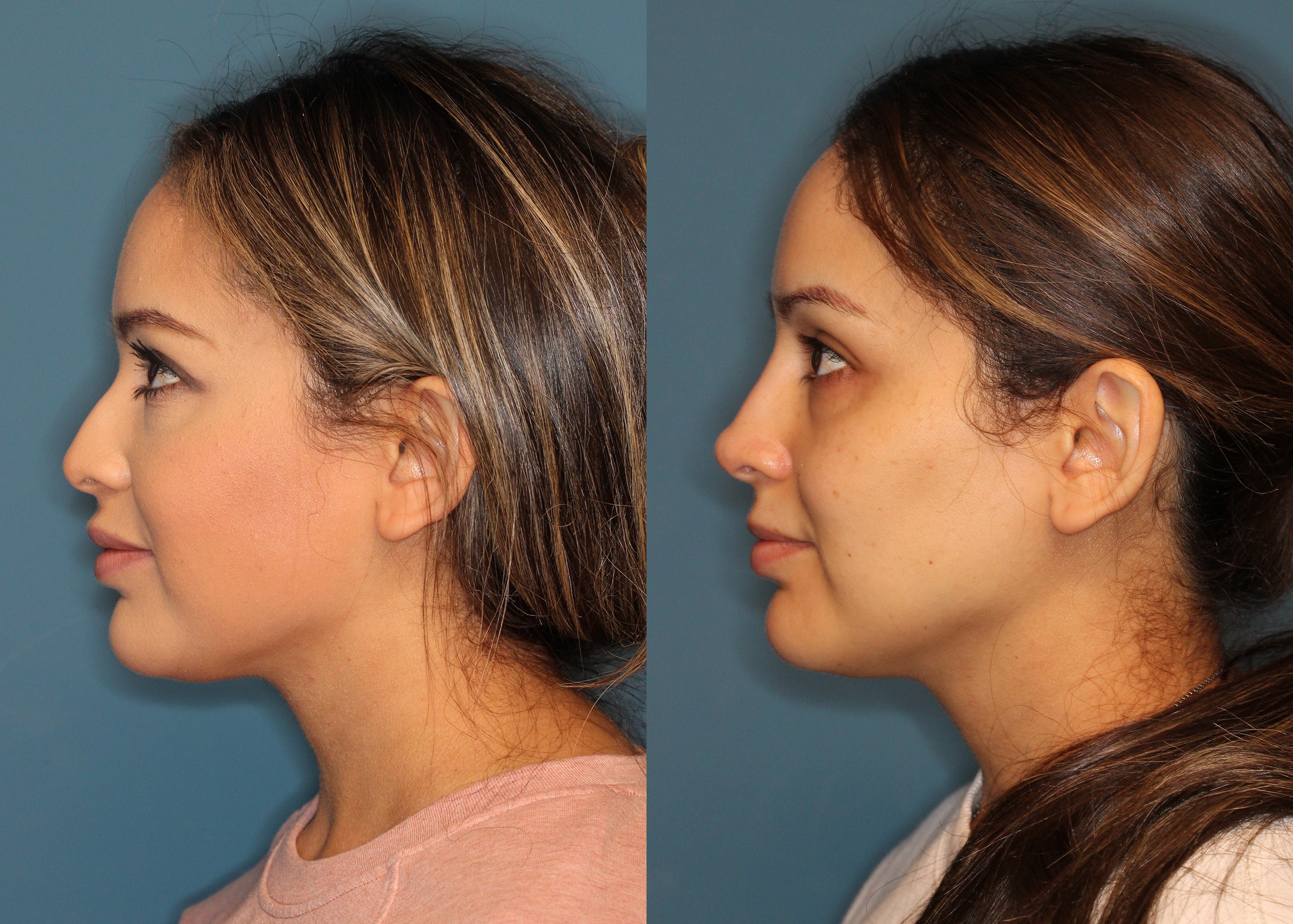 Non Surgical Rhinoplasty Before and After photo by Dr. Abigail Rodriguez in Houston, TX Non Surgical Rhinoplasty Before and After photo by Dr. Abigail Rodriguez in Houston, TX