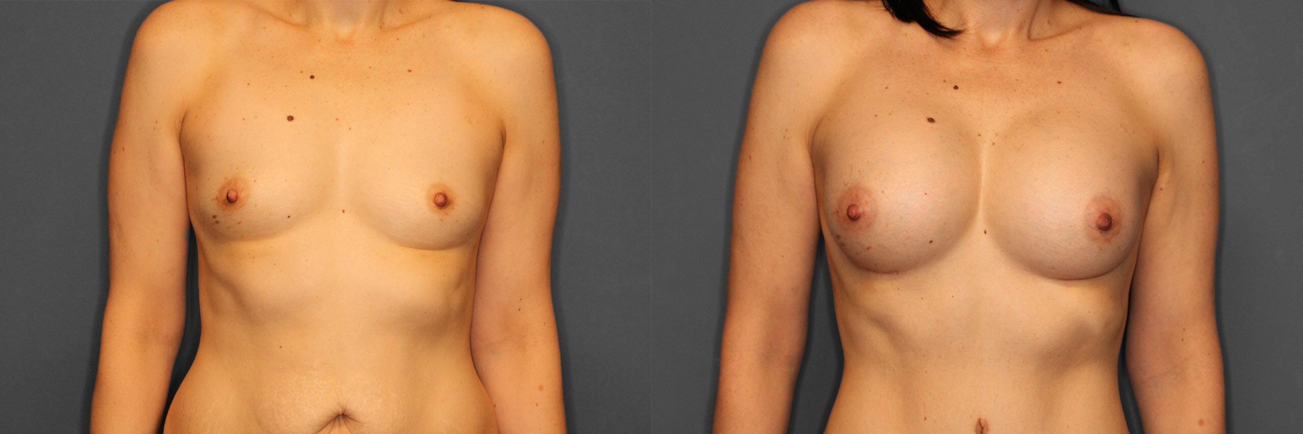 Breast Augmentation Before and After photo by Dr. Abigail Rodriguez in Houston, TX