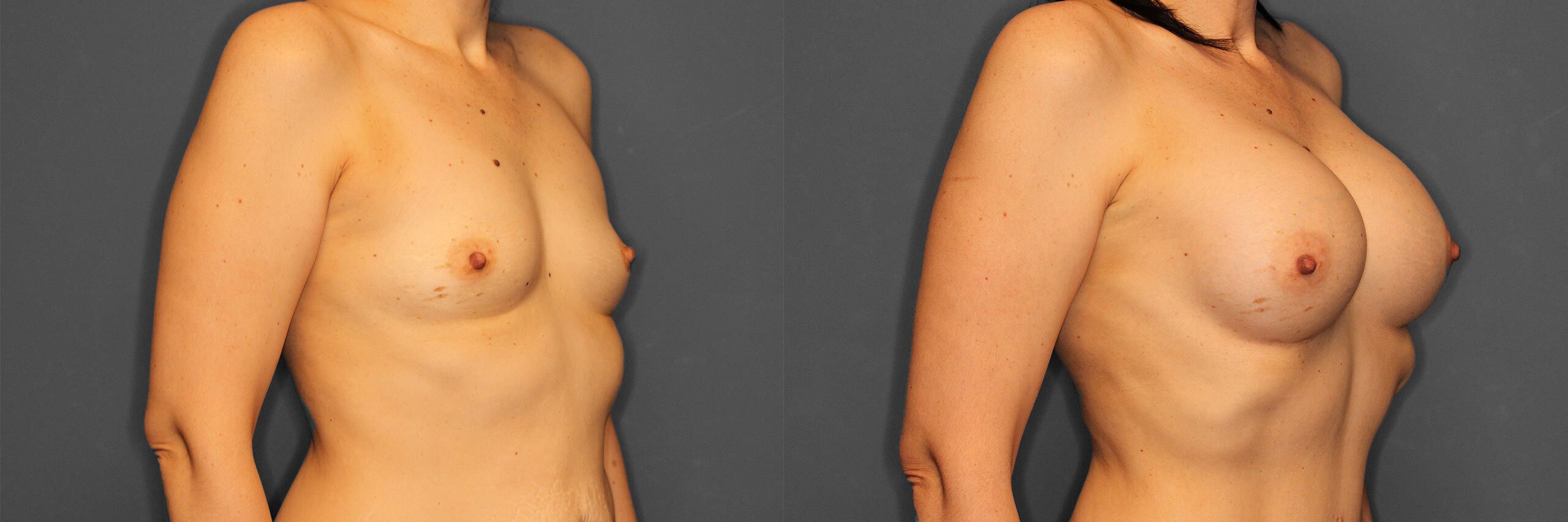 Breast Augmentation Before and After photo by Dr. Abigail Rodriguez in Houston, TX