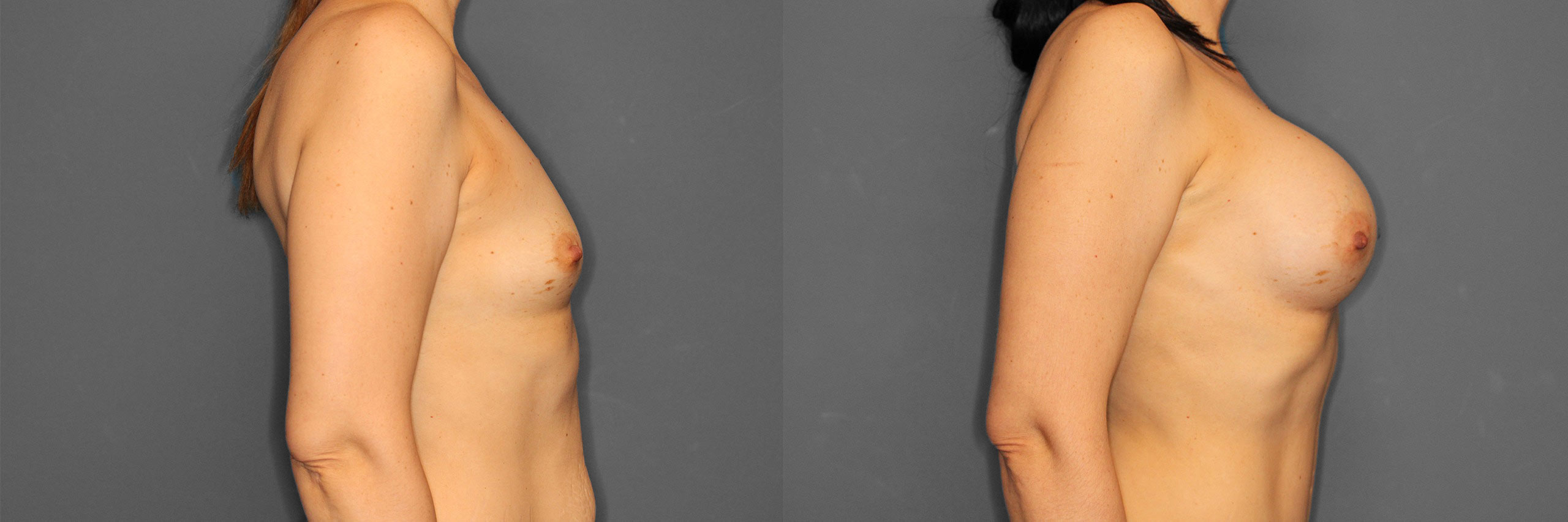 Breast Augmentation Before and After photo by Dr. Abigail Rodriguez in Houston, TX