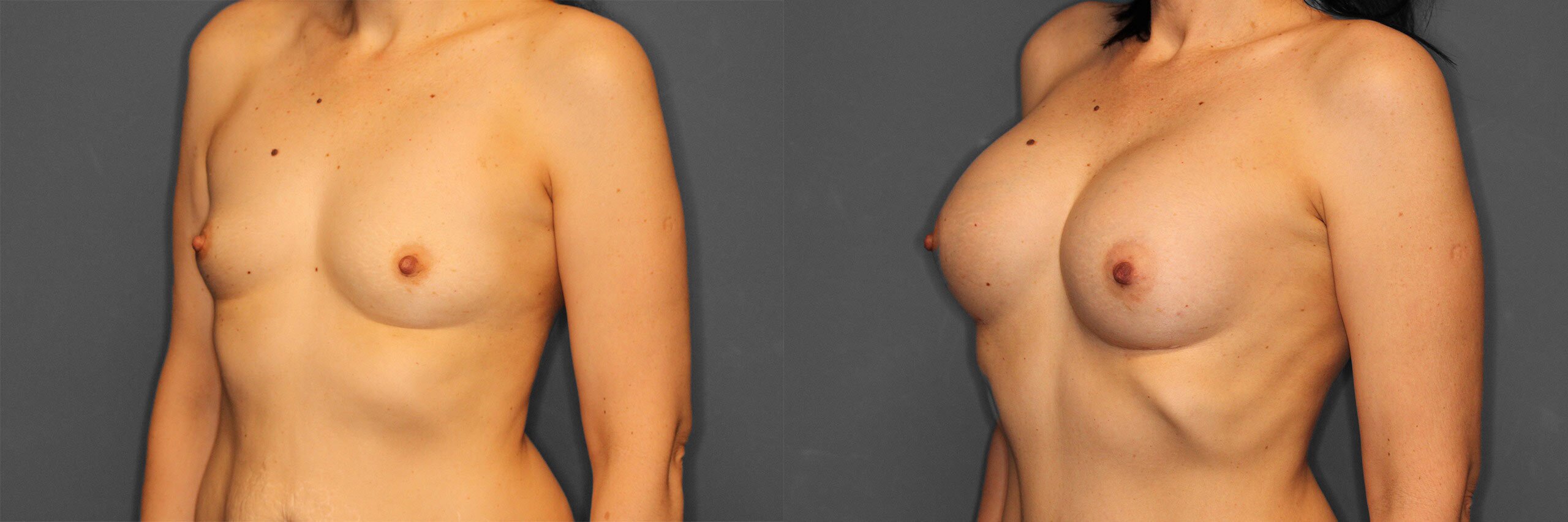 Breast Augmentation Before and After photo by Dr. Abigail Rodriguez in Houston, TX