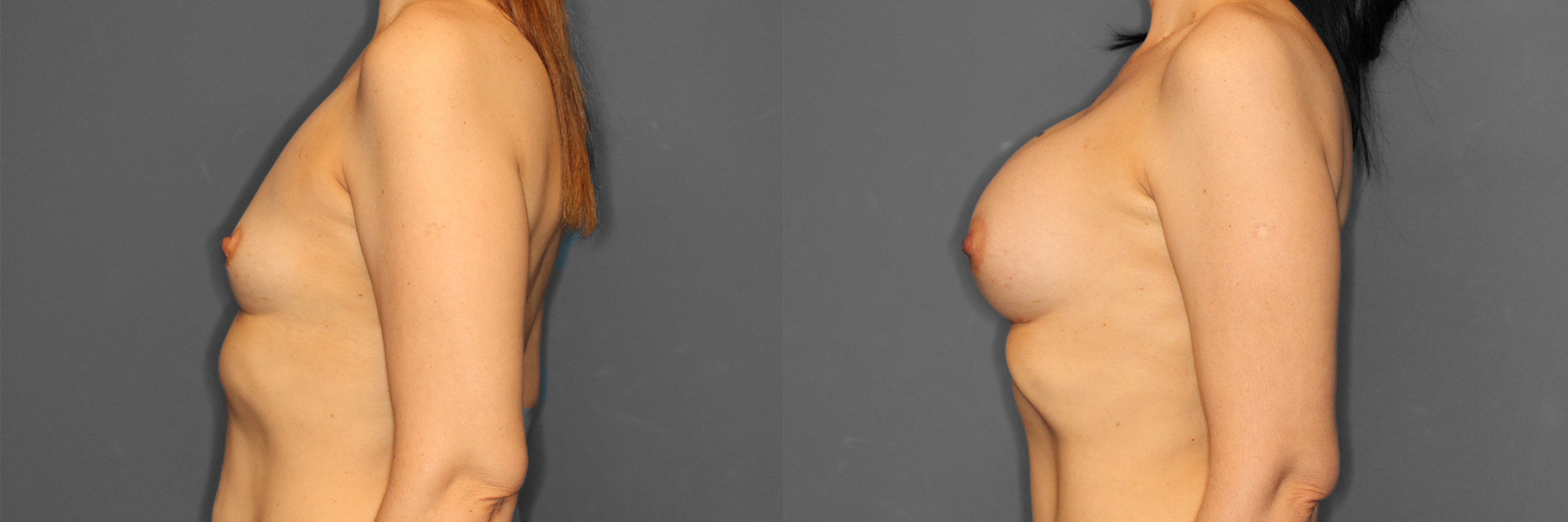 Breast Augmentation Before and After photo by Dr. Abigail Rodriguez in Houston, TX