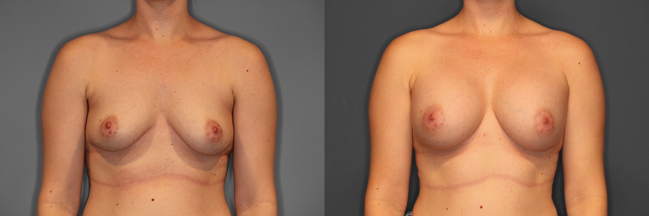 Breast Augmentation Before and After photo by Dr. Abigail Rodriguez in Houston, TX