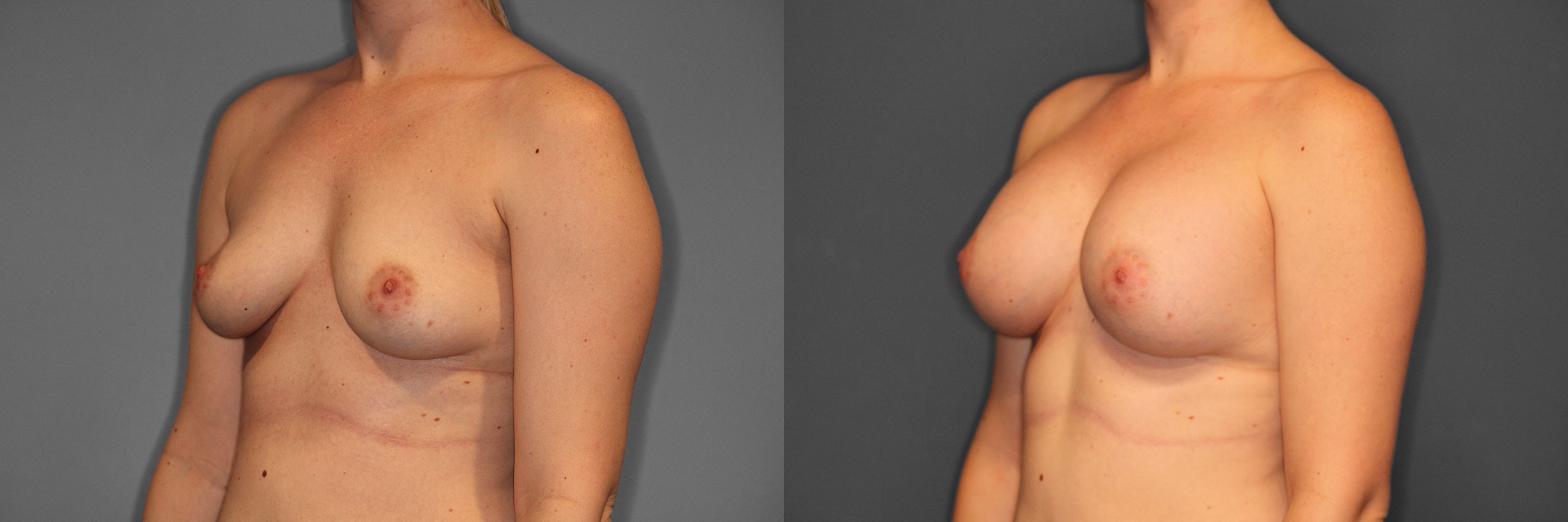 Breast Augmentation Before and After photo by Dr. Abigail Rodriguez in Houston, TX