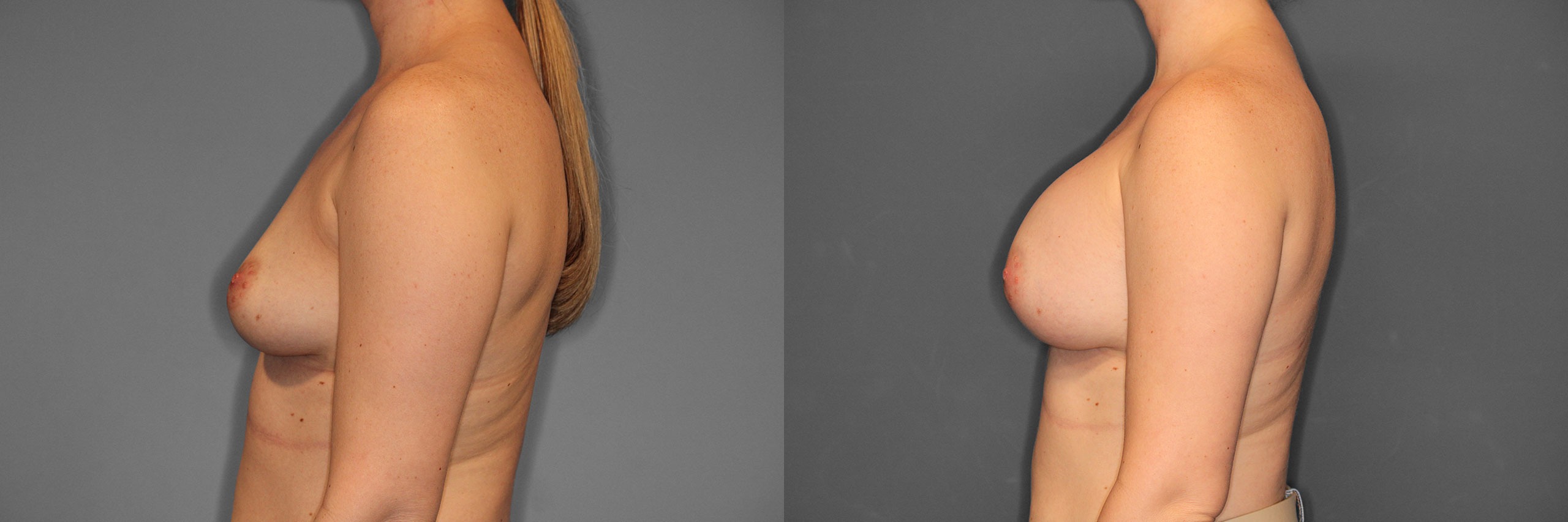 Breast Augmentation Before and After photo by Dr. Abigail Rodriguez in Houston, TX