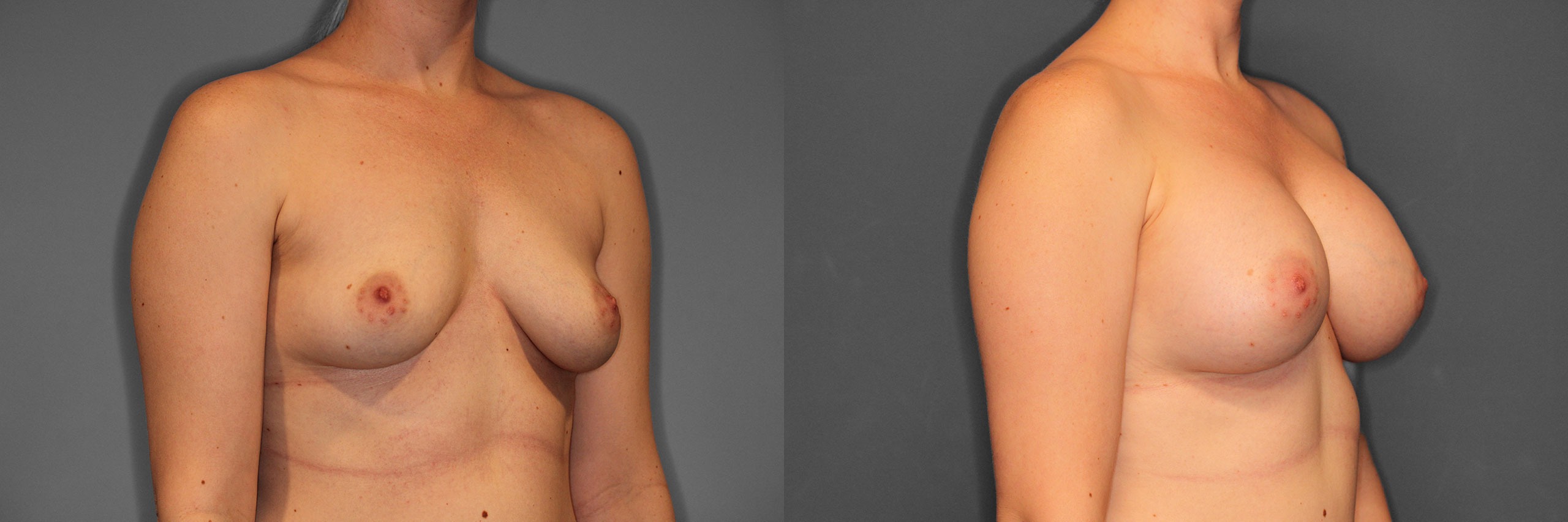 Breast Augmentation Before and After photo by Dr. Abigail Rodriguez in Houston, TX