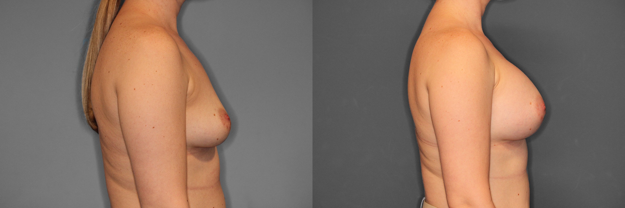 Breast Augmentation Before and After photo by Dr. Abigail Rodriguez in Houston, TX