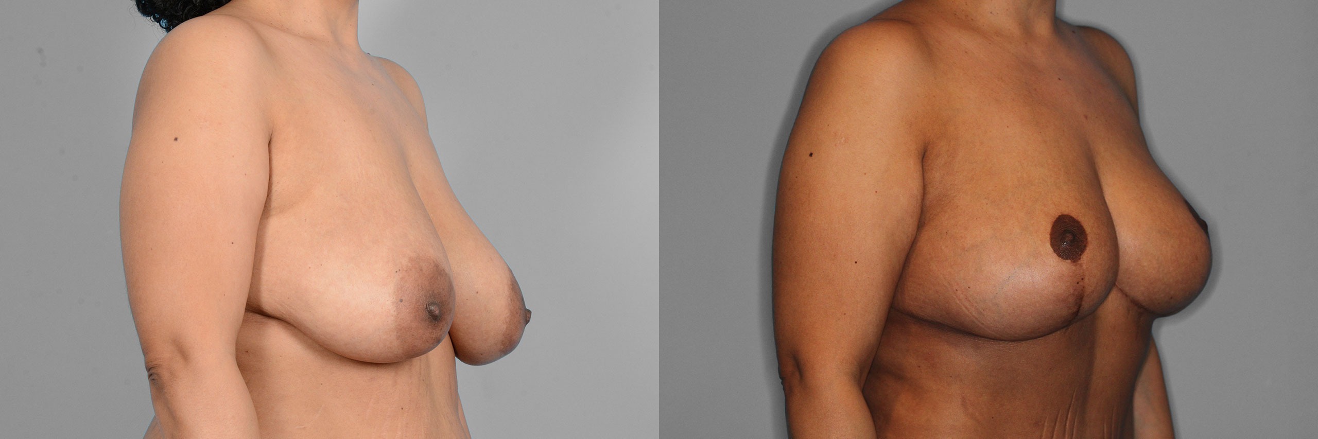 Breast Lift + Augmentation Before and After photo by Dr. Abigail Rodriguez in Houston, TX