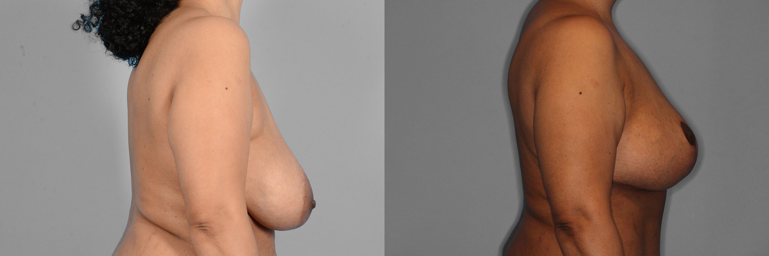 Breast Lift + Augmentation Before and After photo by Dr. Abigail Rodriguez in Houston, TX