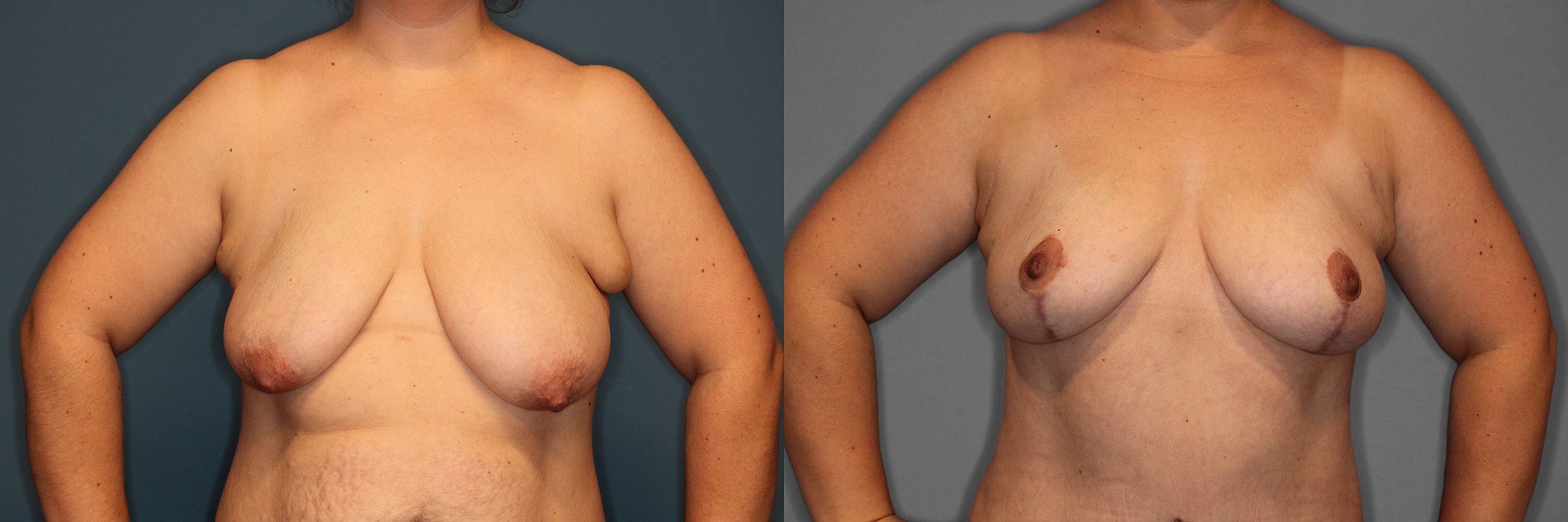 Breast Lift Before and After photo by Dr. Abigail Rodriguez in Houston, TX