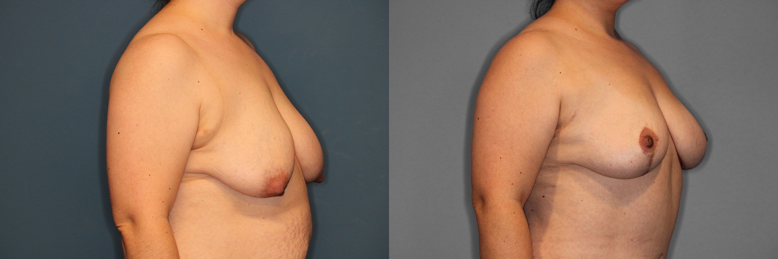Breast Lift Before and After photo by Dr. Abigail Rodriguez in Houston, TX