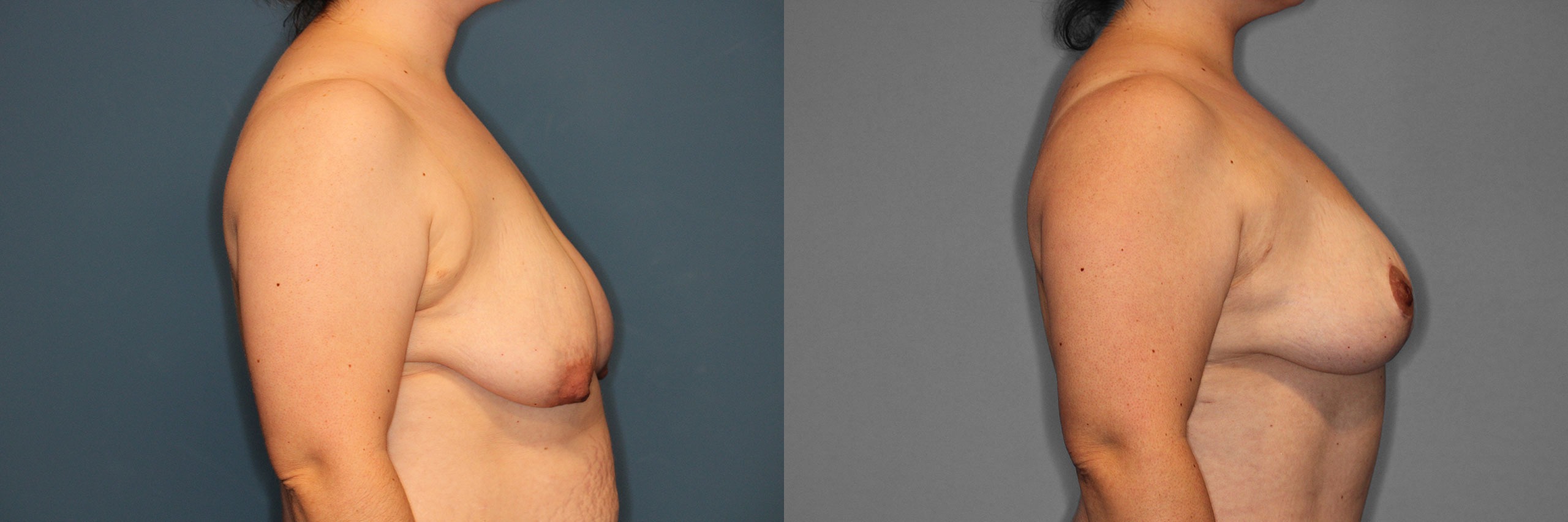 Breast Lift Before and After photo by Dr. Abigail Rodriguez in Houston, TX