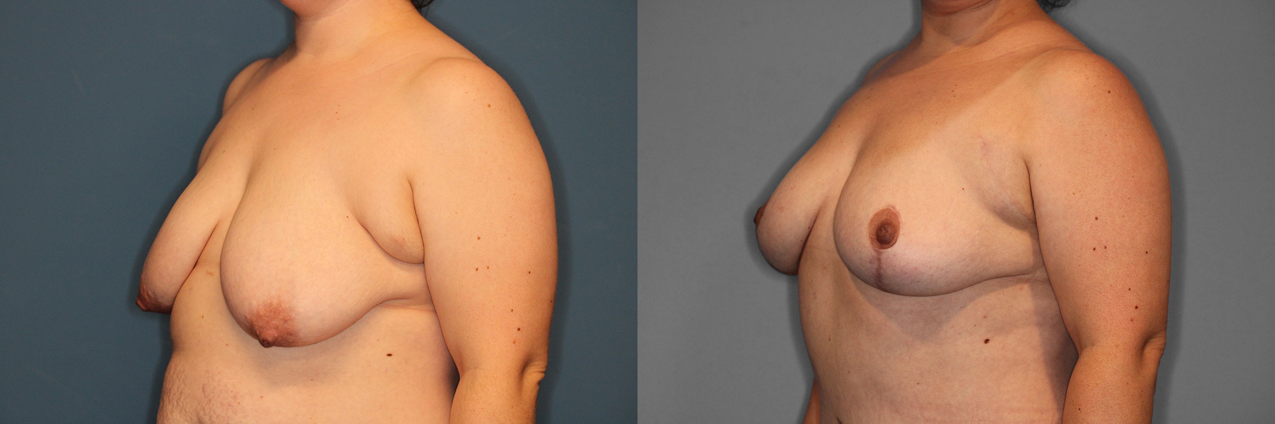 Breast Lift Before and After photo by Dr. Abigail Rodriguez in Houston, TX